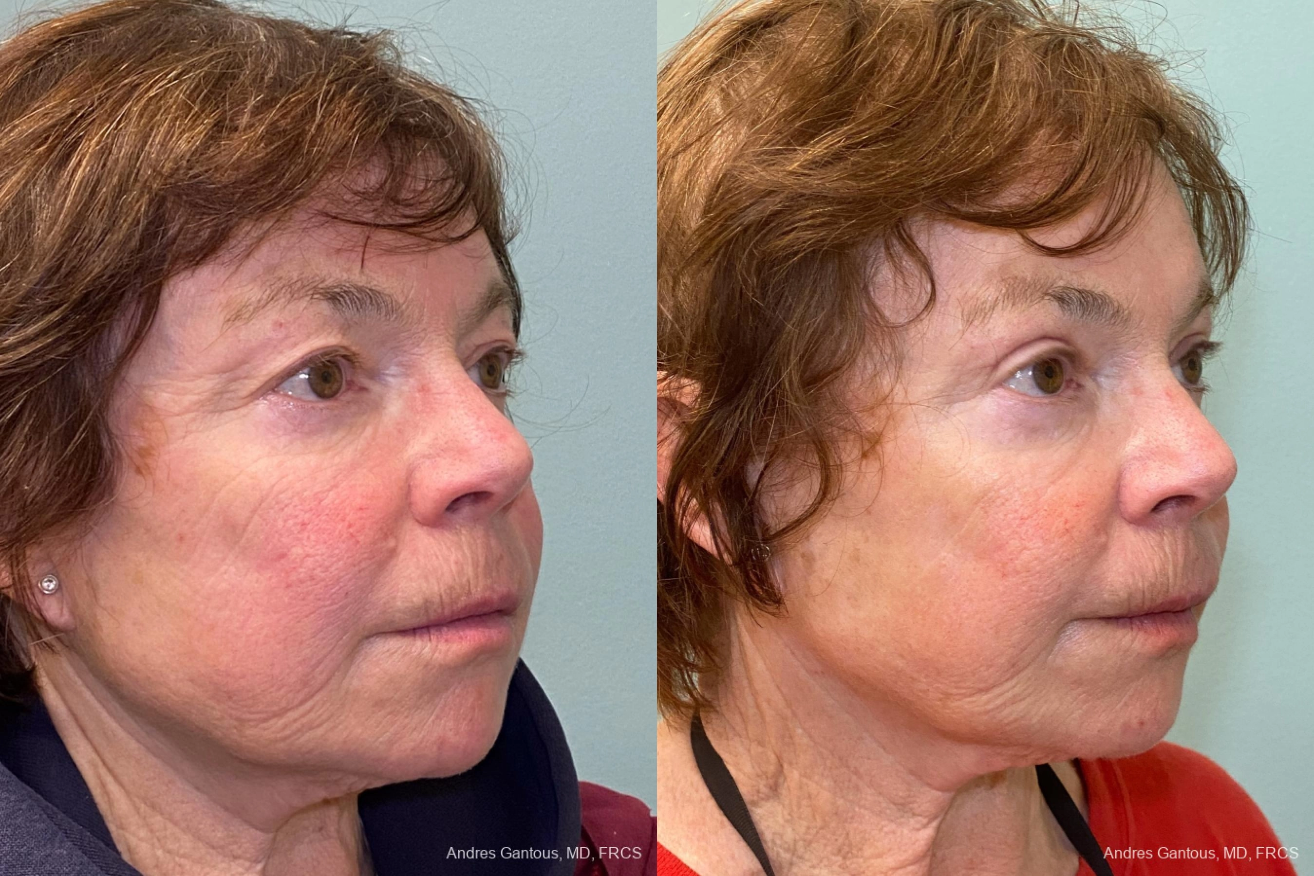 Blepharoplasty - Thumbnail 2