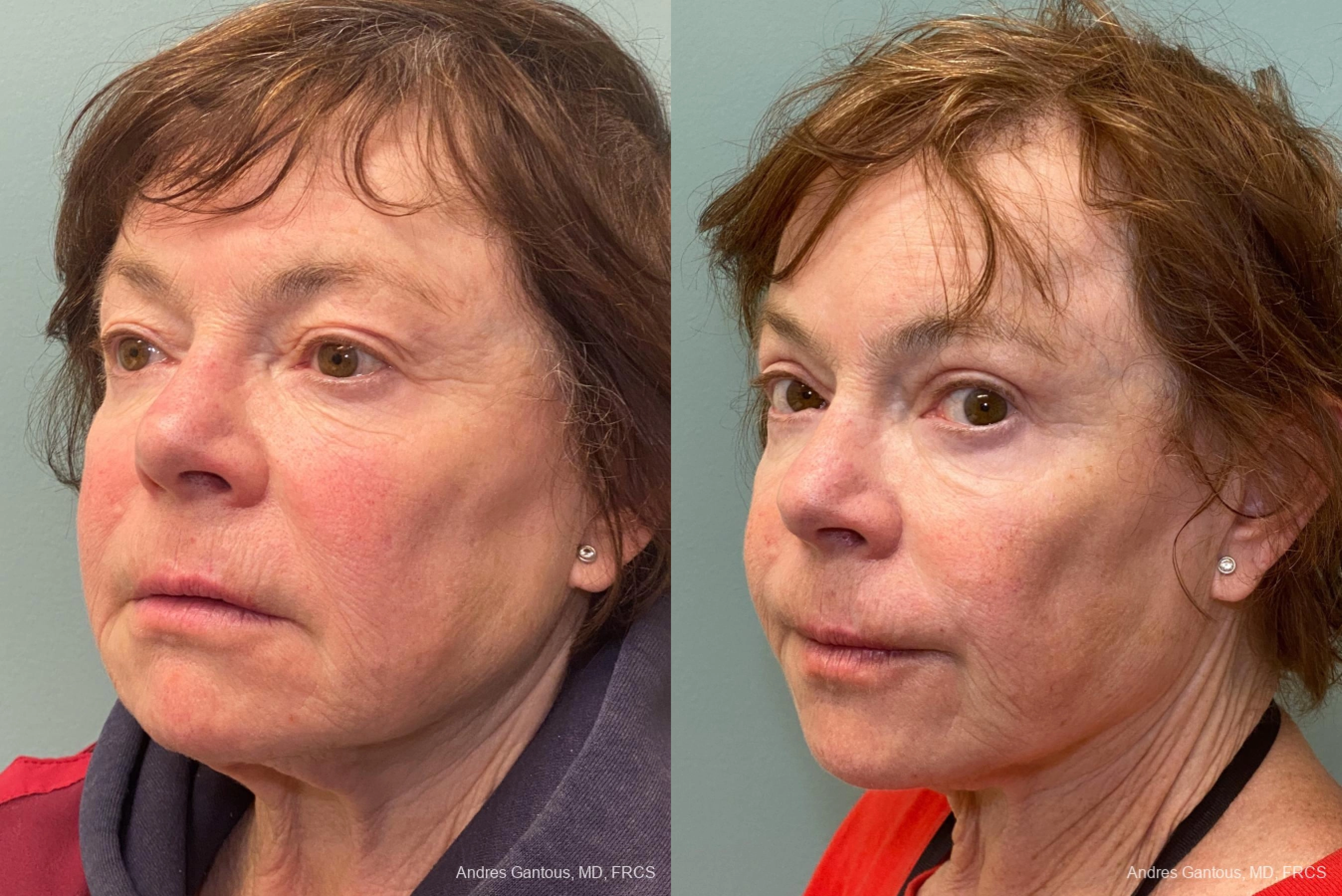 Blepharoplasty - Thumbnail 4