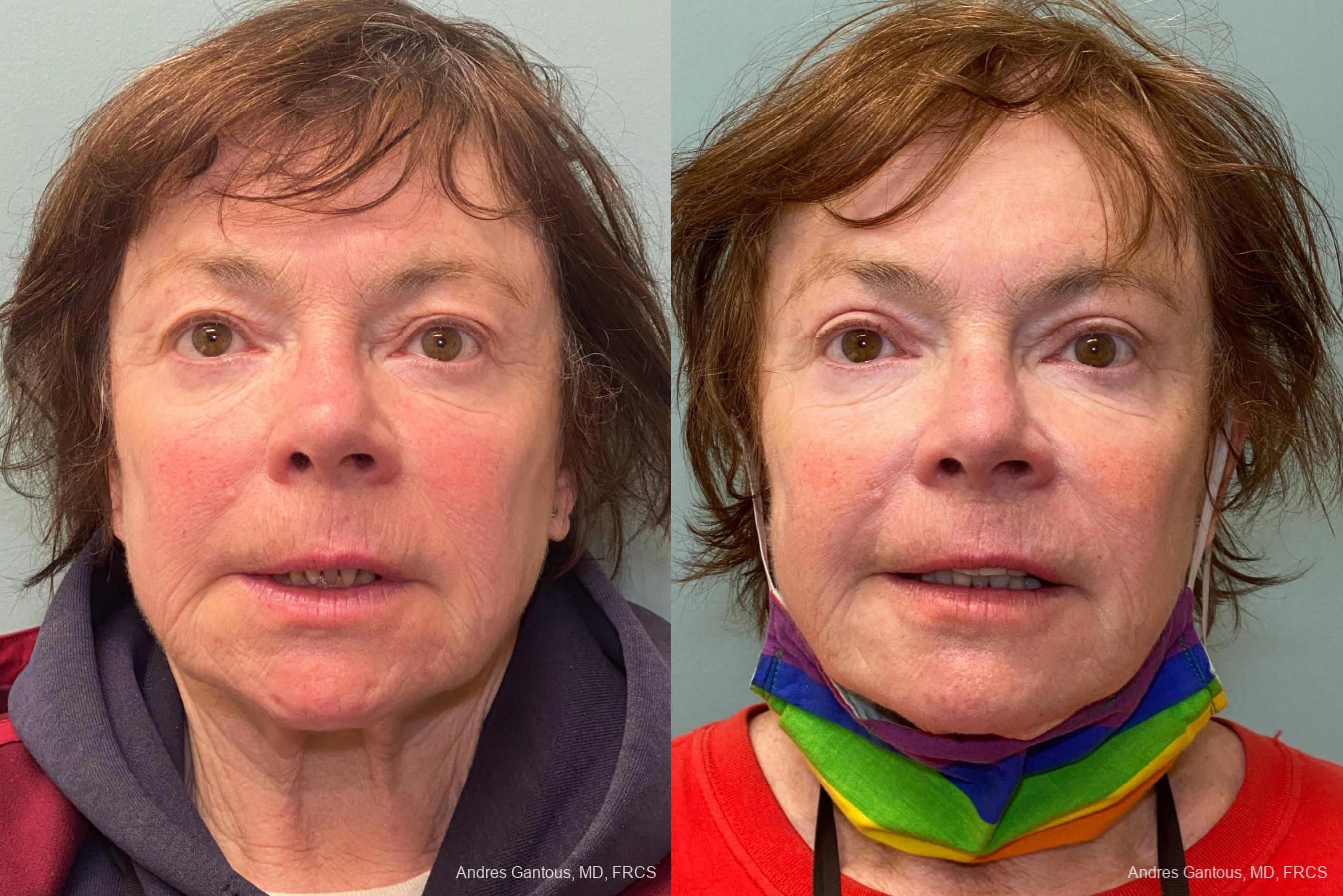 Face Procedures - Case 11748