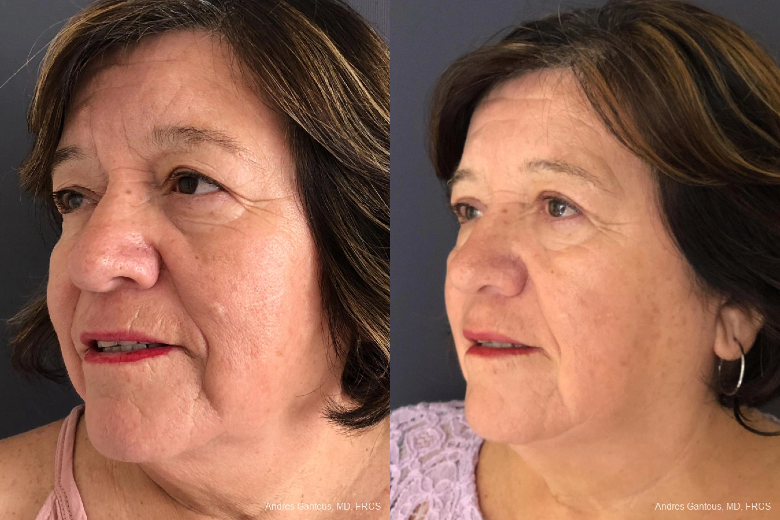 Blepharoplasty - Thumbnail 2