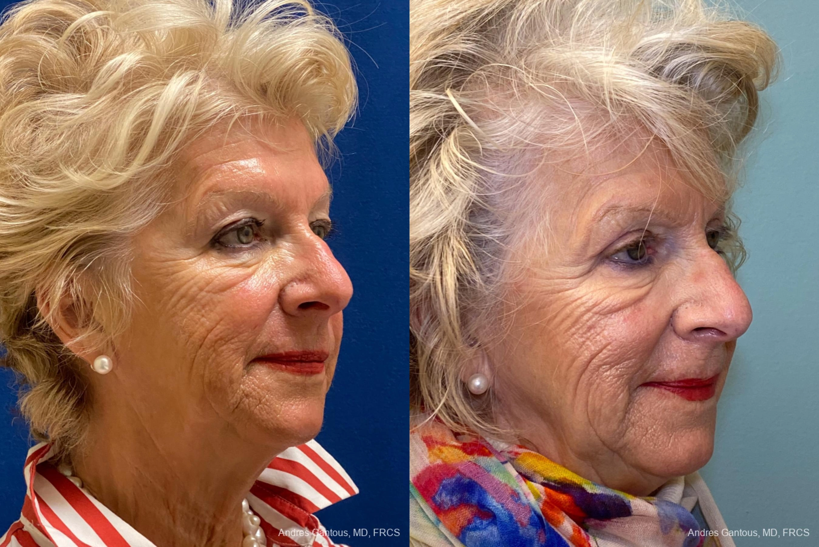 Blepharoplasty - Thumbnail 2