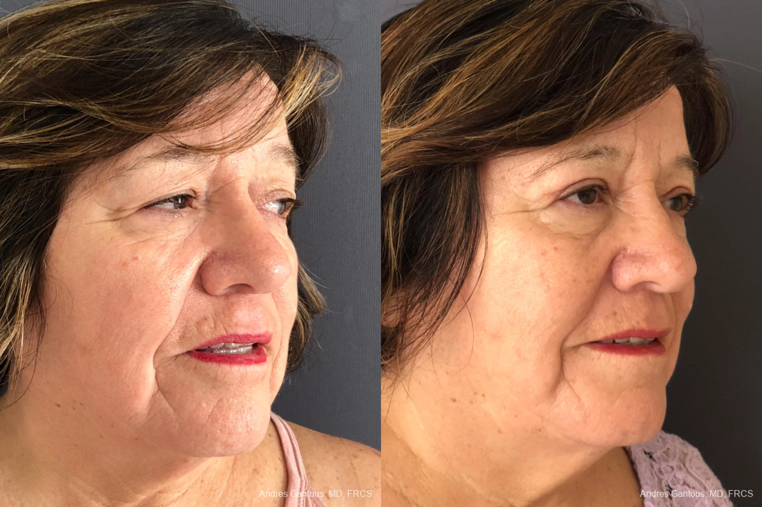 Blepharoplasty - Thumbnail 4