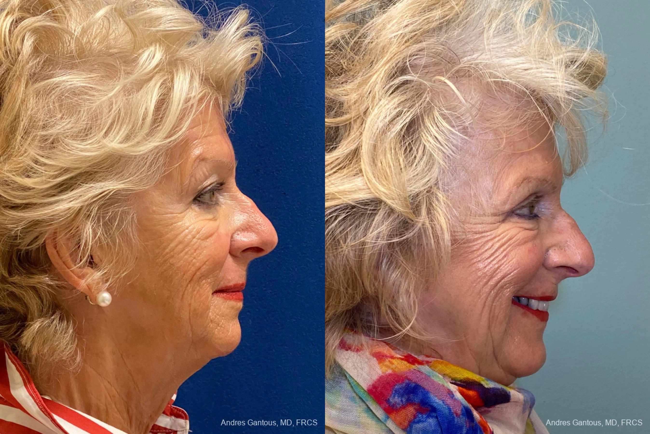 Blepharoplasty - Thumbnail 3