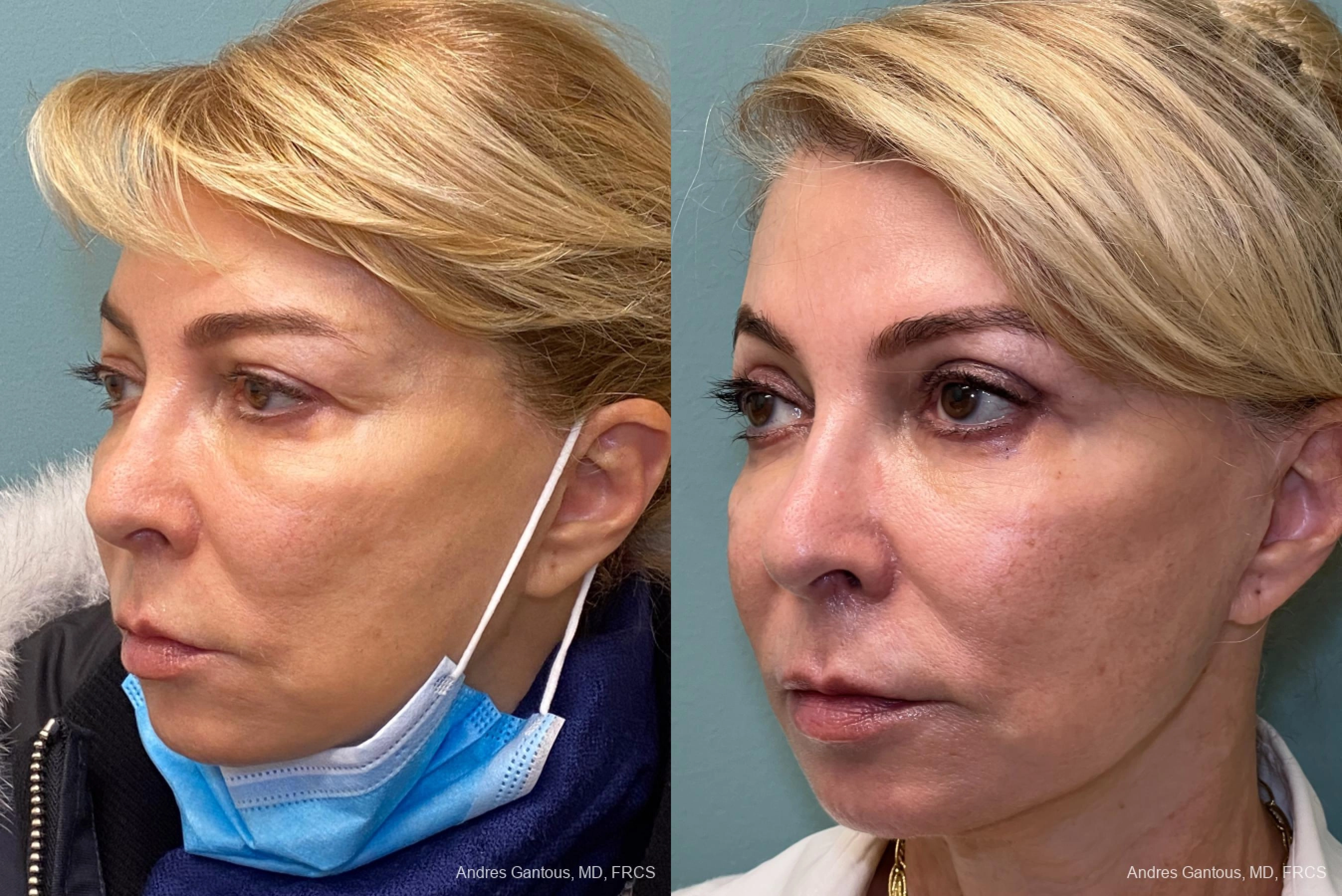 Blepharoplasty - Thumbnail 4