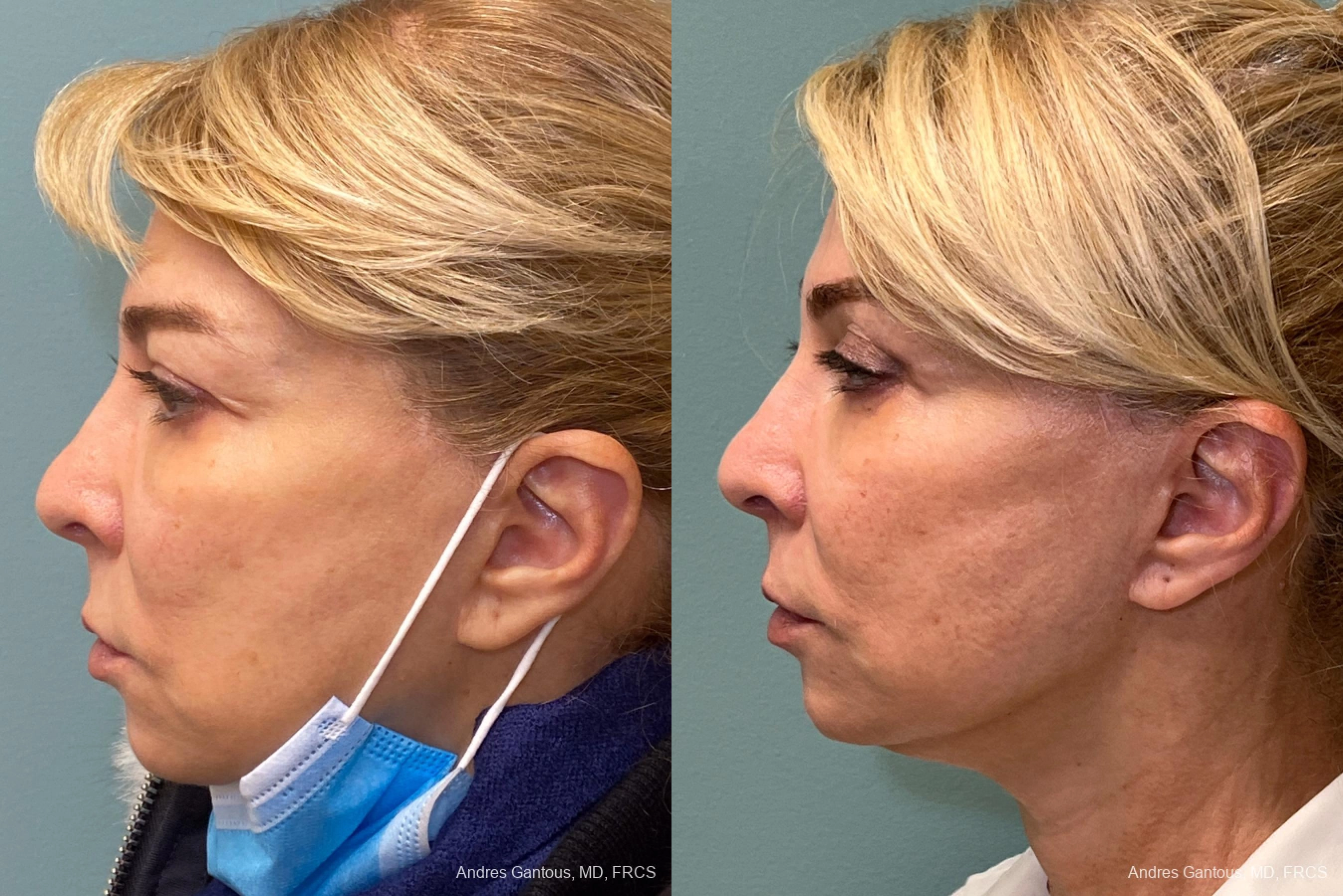 Blepharoplasty - Thumbnail 5