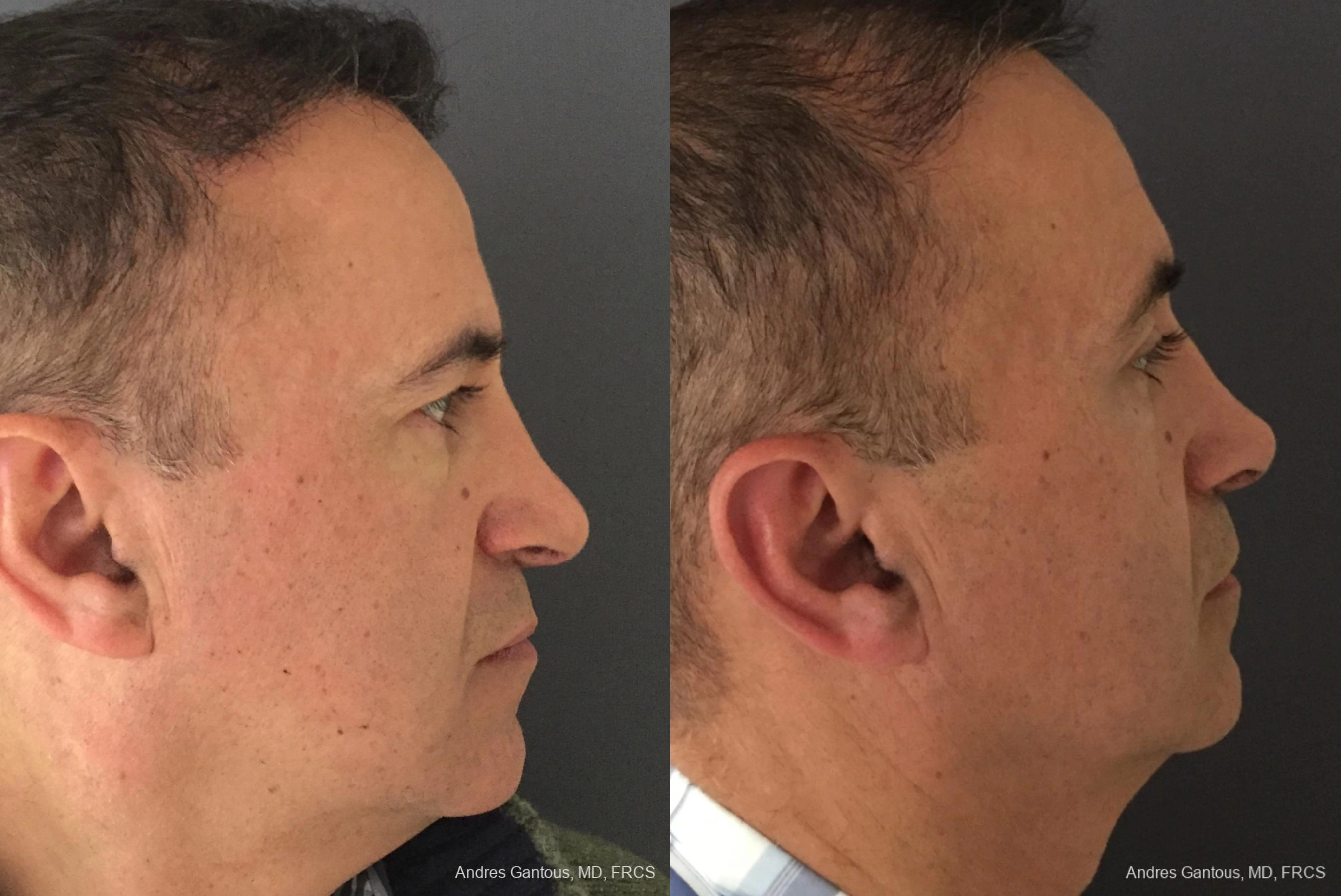 Blepharoplasty - Thumbnail 3