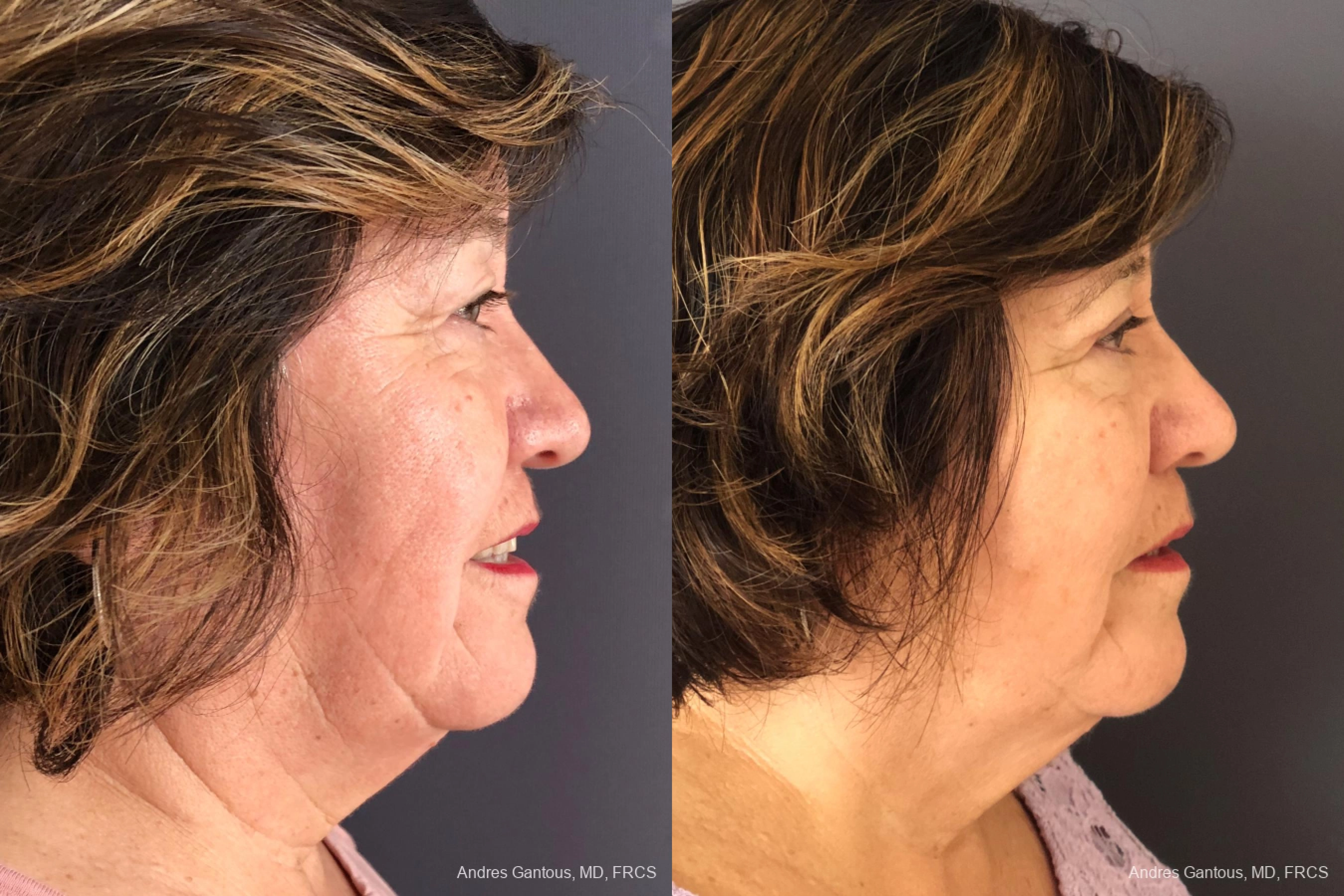 Blepharoplasty - Thumbnail 5