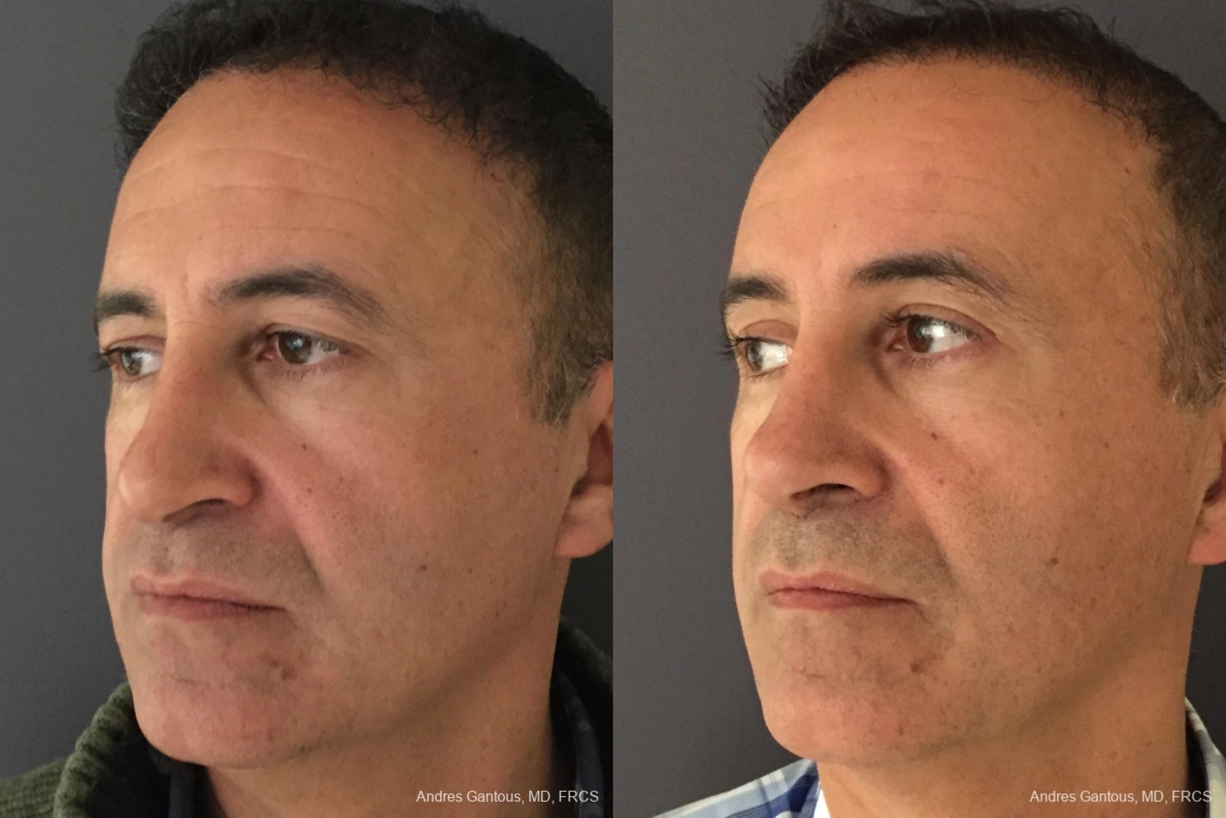 Blepharoplasty - Thumbnail 4