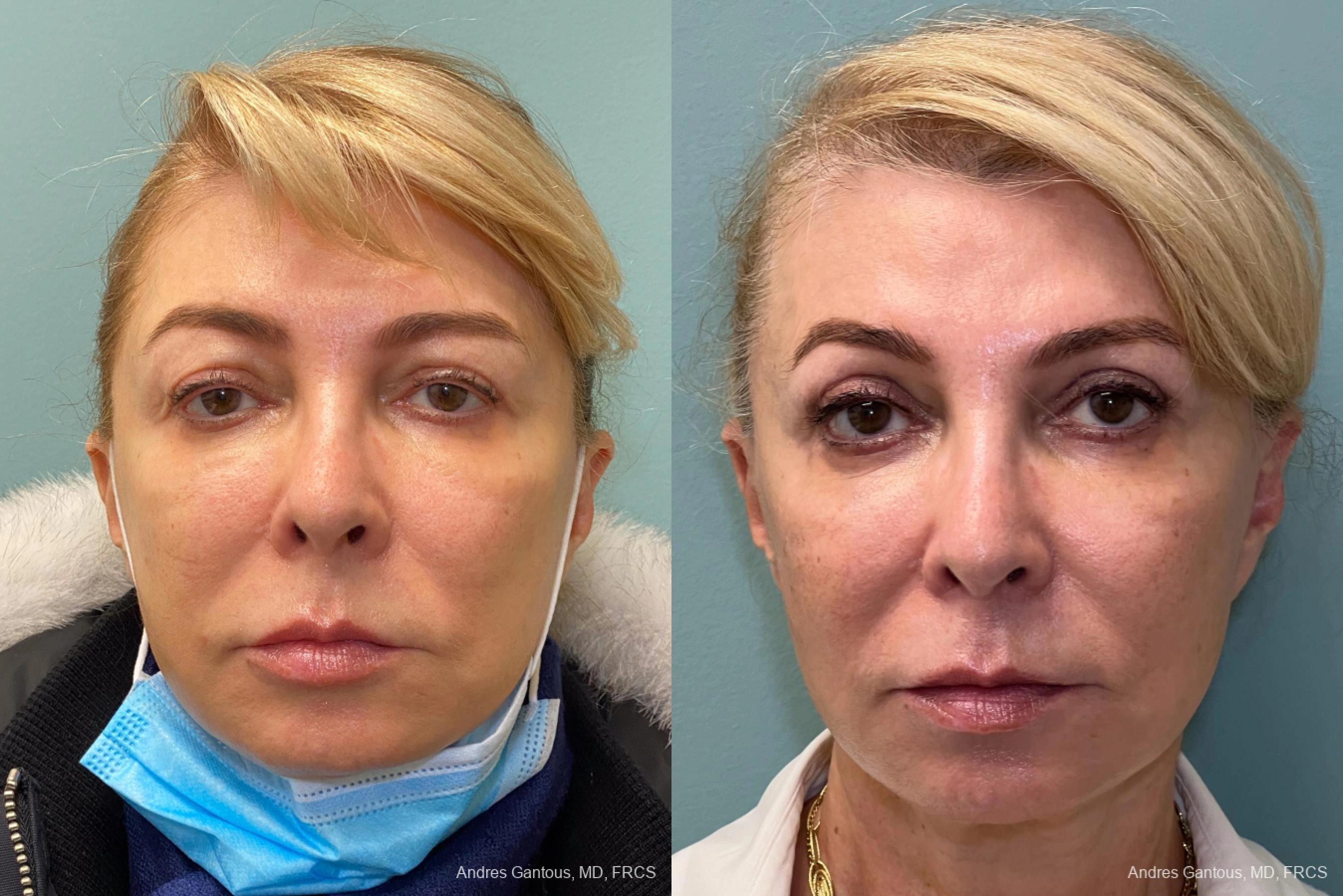 Blepharoplasty - Case 6583
