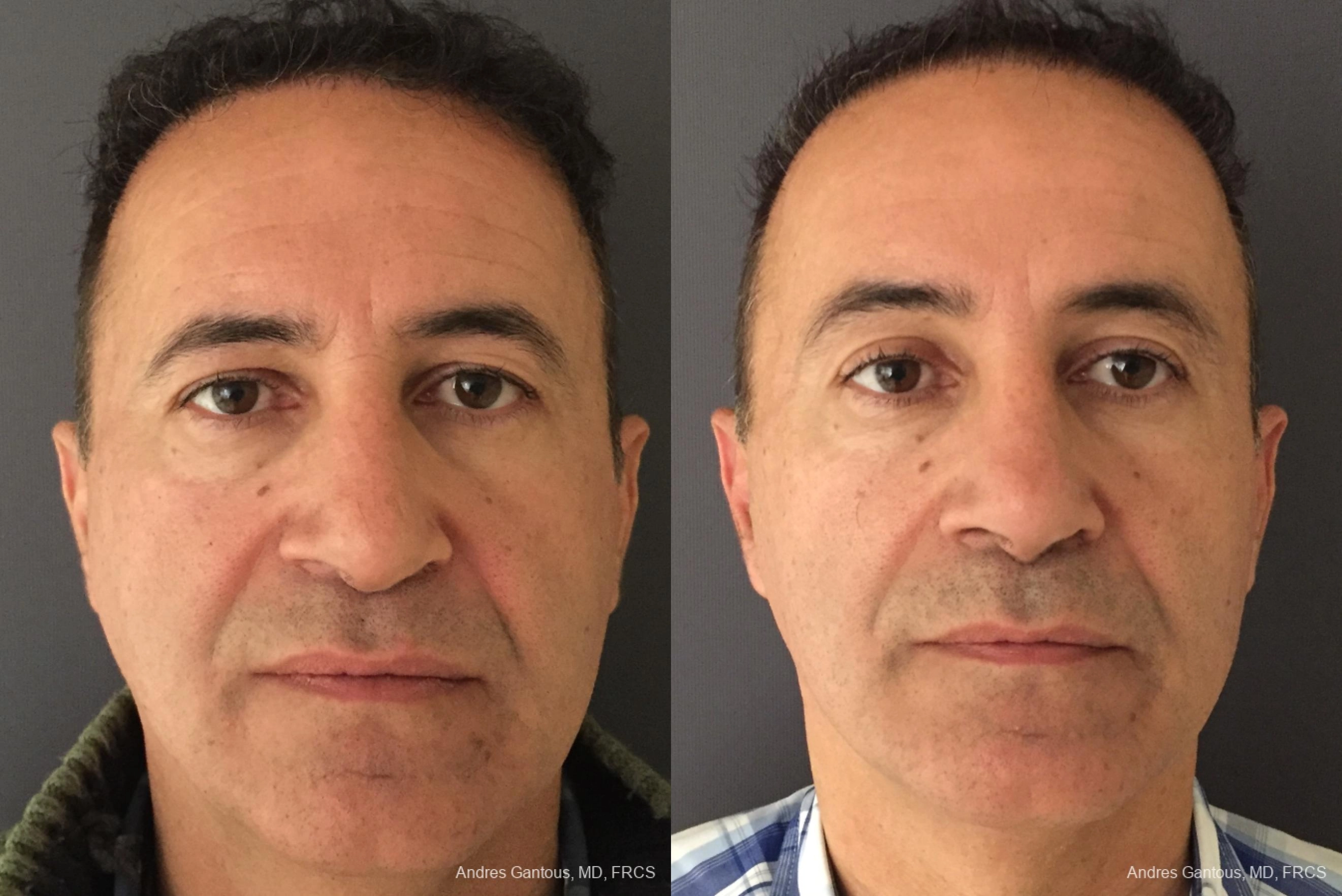 Face Procedures - Case 11764