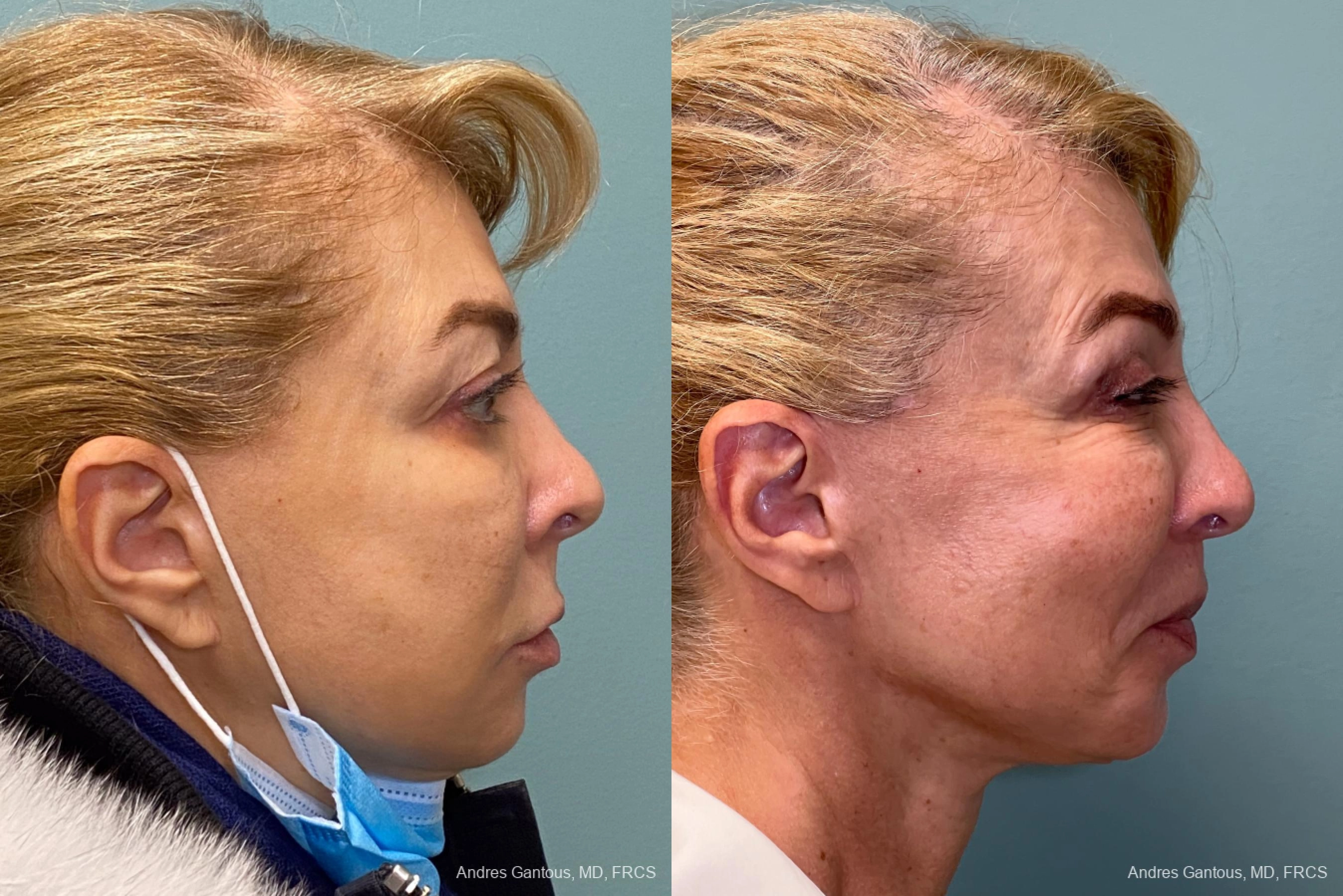 Blepharoplasty - Thumbnail 3