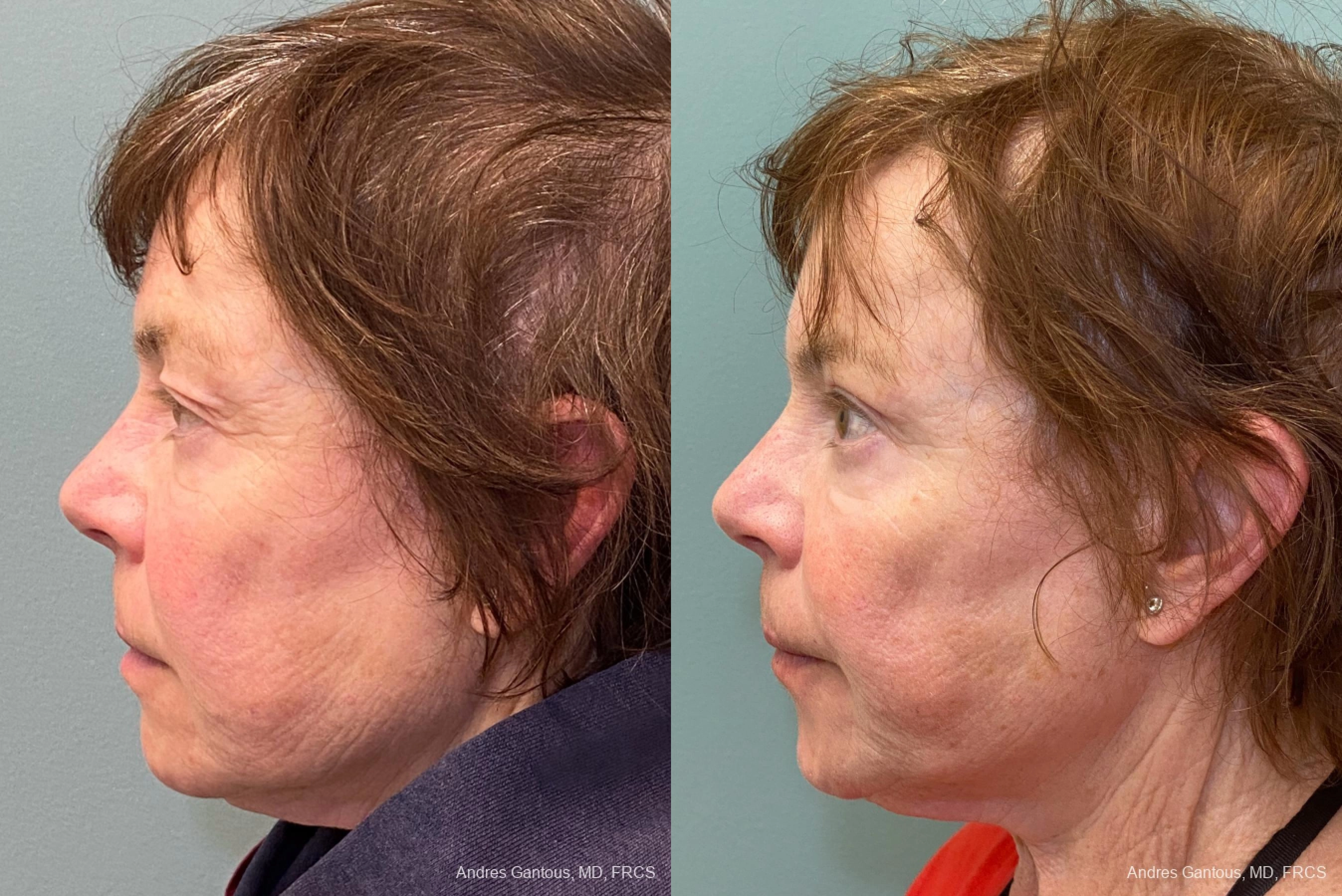 Blepharoplasty - Thumbnail 5