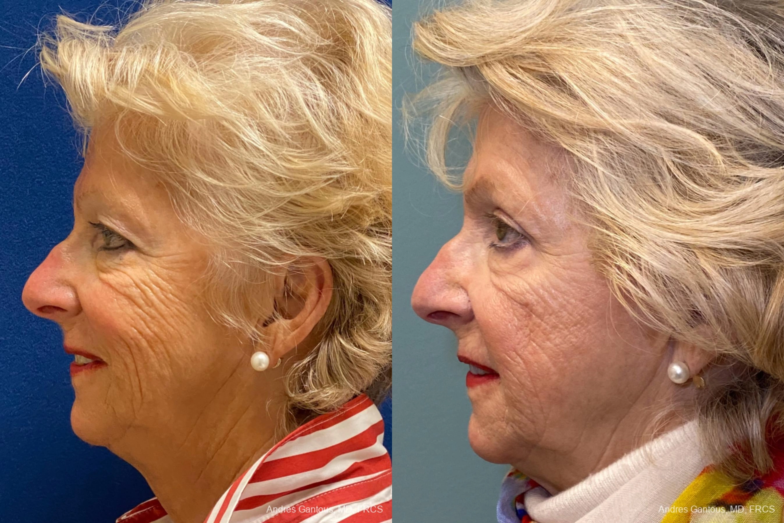 Blepharoplasty - Thumbnail 5