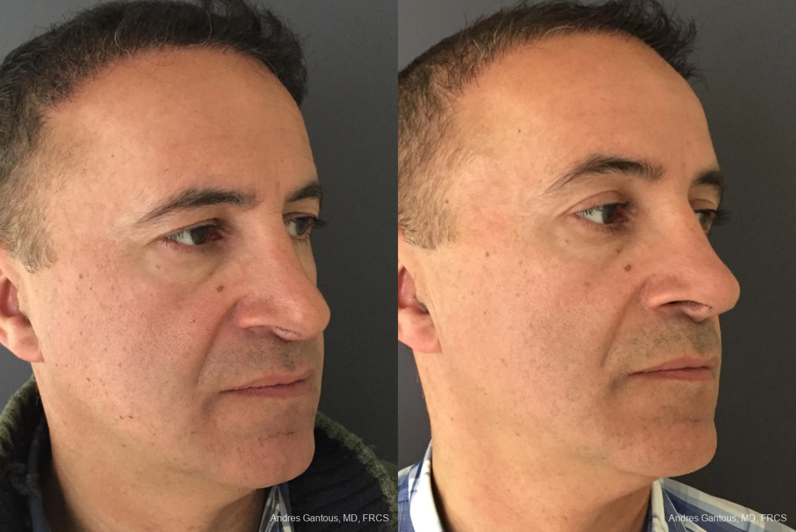 Blepharoplasty - Thumbnail 2