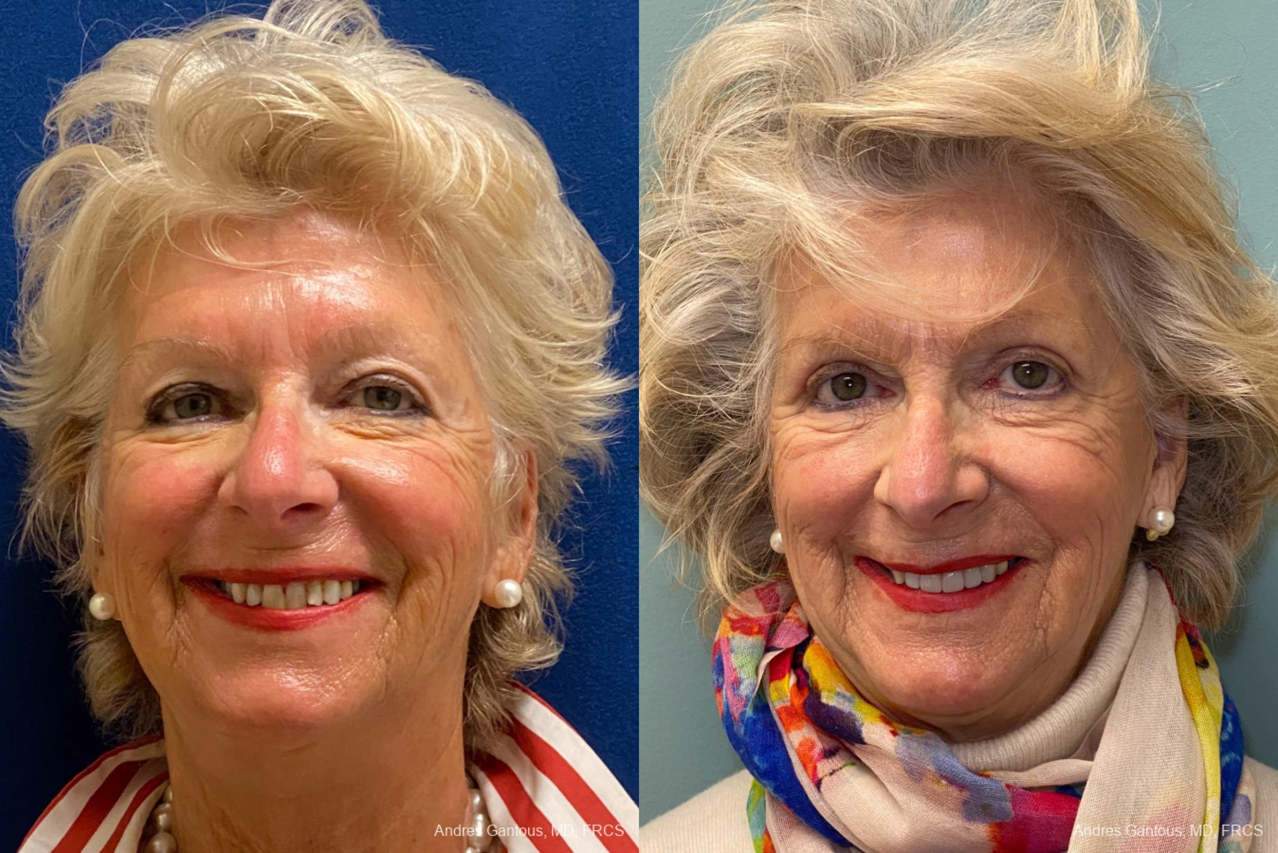 Face Procedures - Case 11761