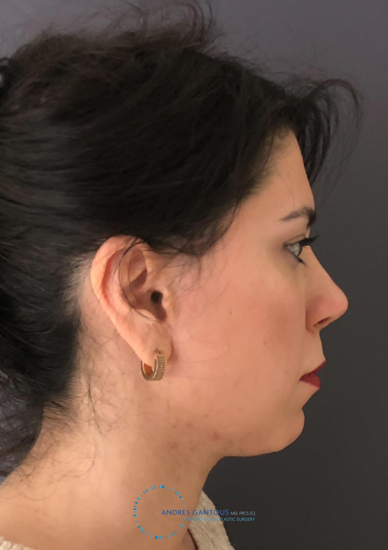 Revision Rhinoplasty: Patient 18 - After 5