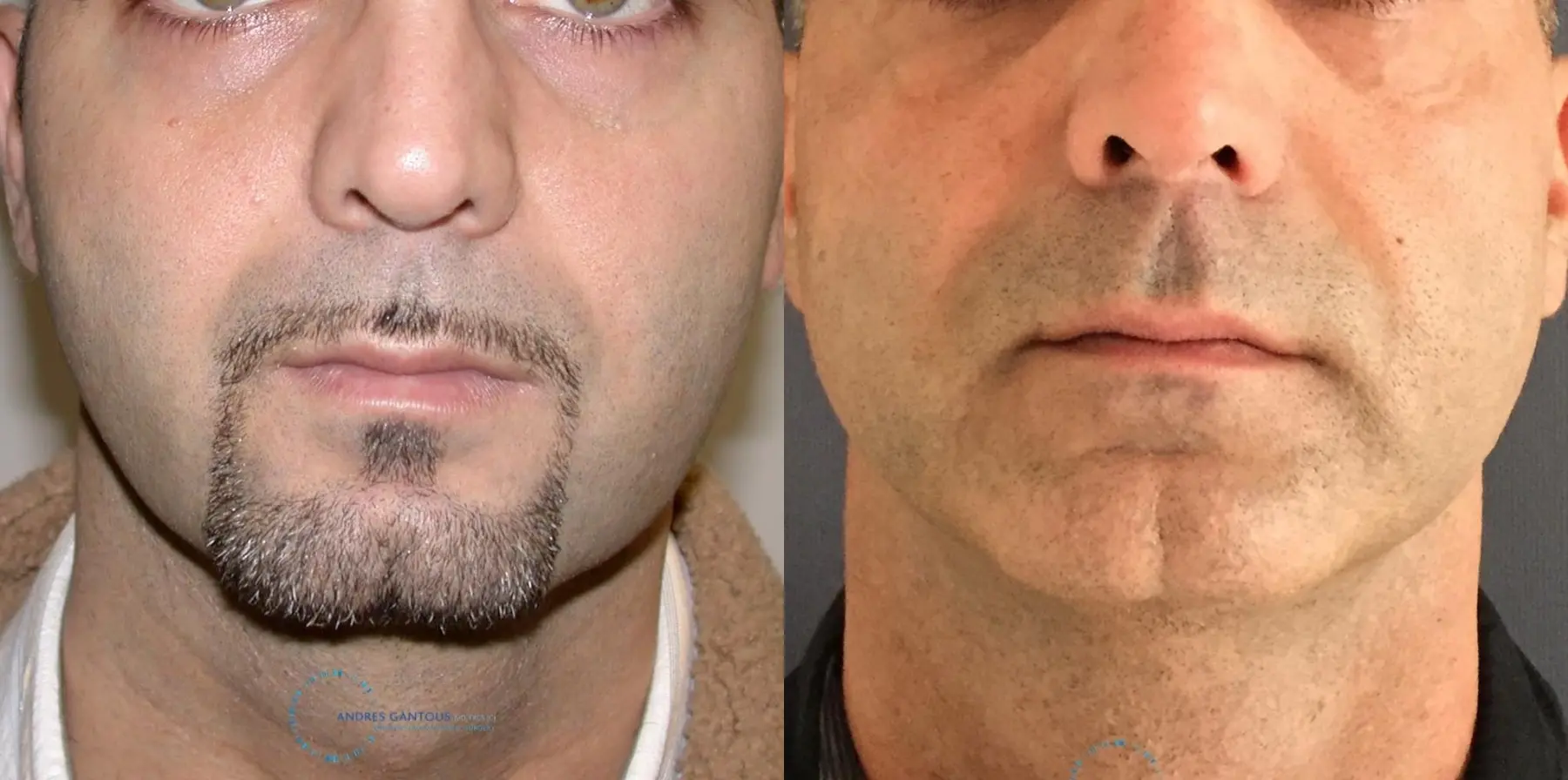 Chin Augmentation: Patient 2 - Before and After 1