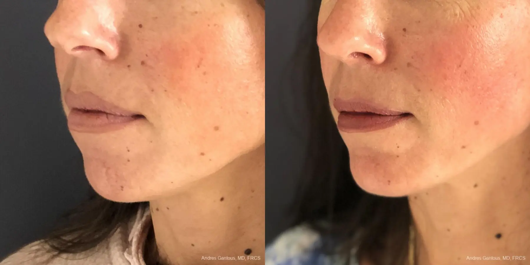 Chin Augmentation: Patient 7 - Before and After  