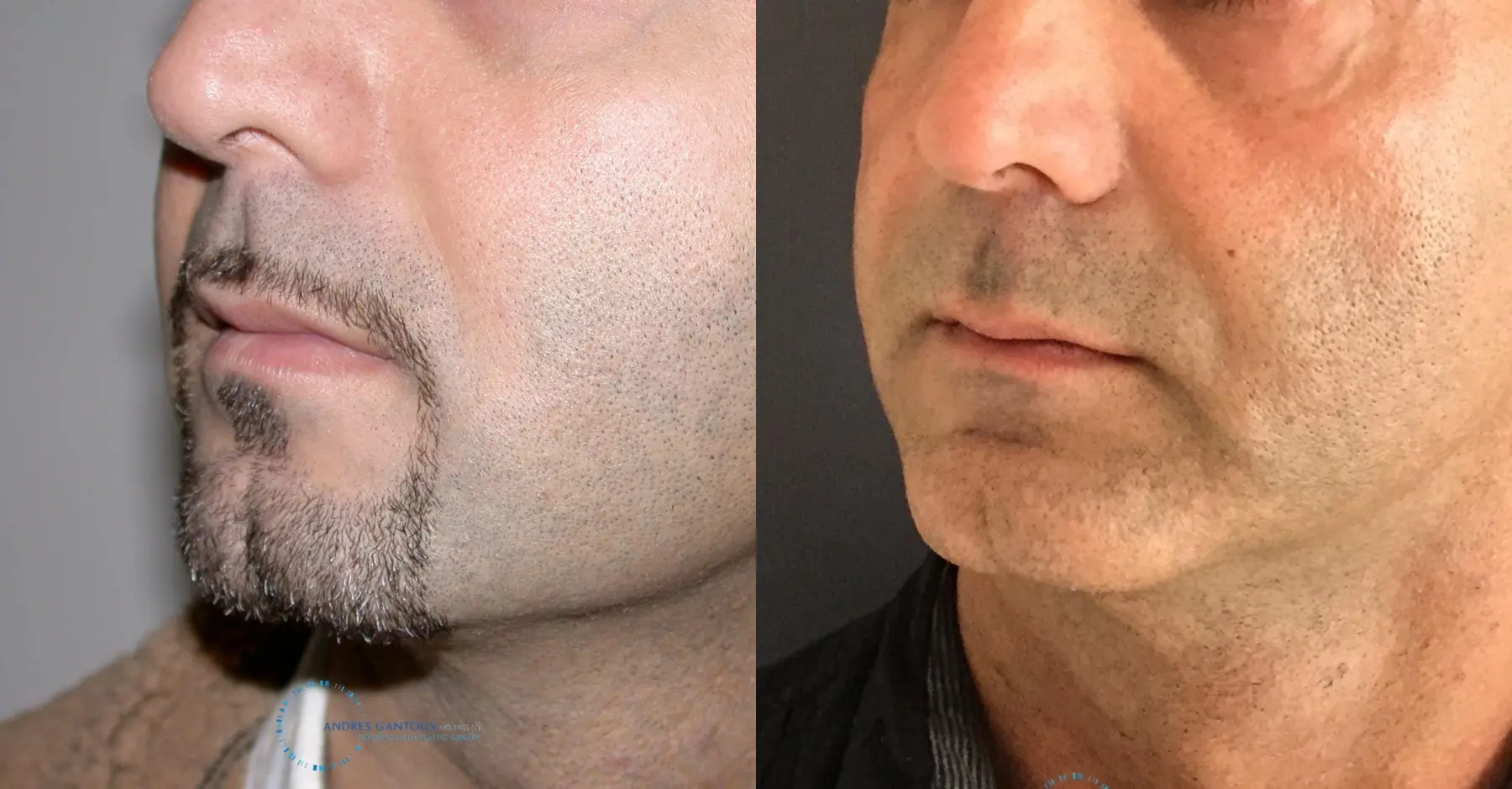 Chin Augmentation: Patient 2 - Before and After 2