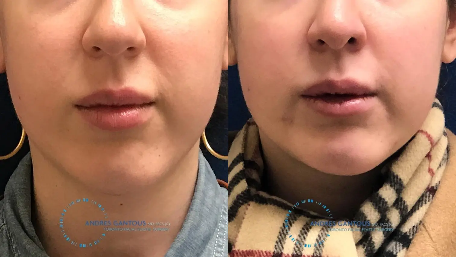 Chin Augmentation: Patient 8 - Before and After 1