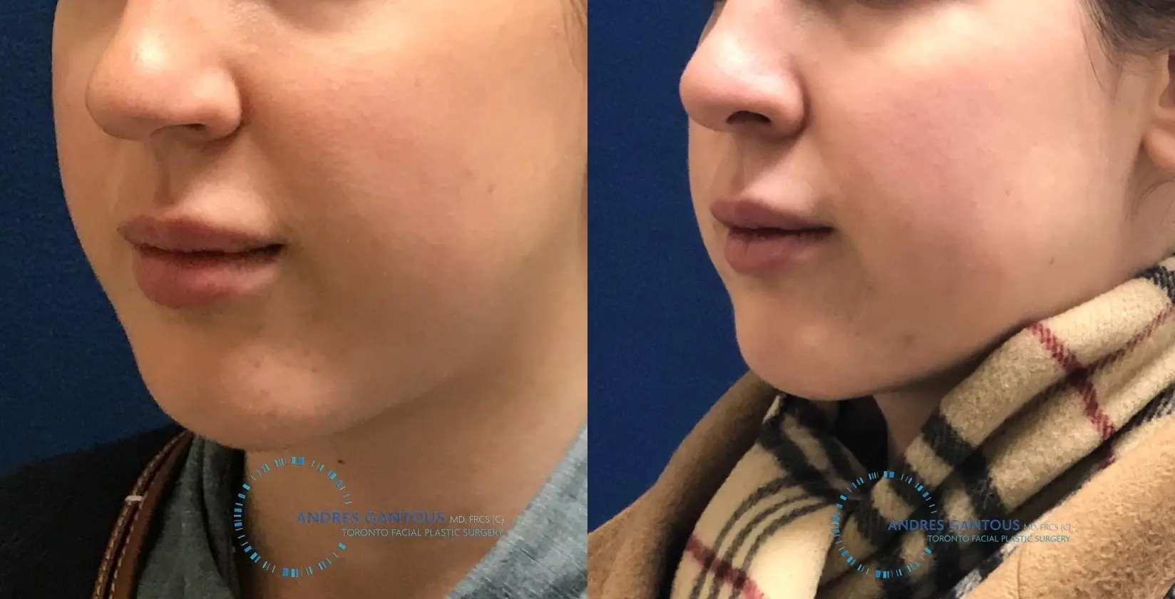 Chin Augmentation: Patient 8 - Before and After 2