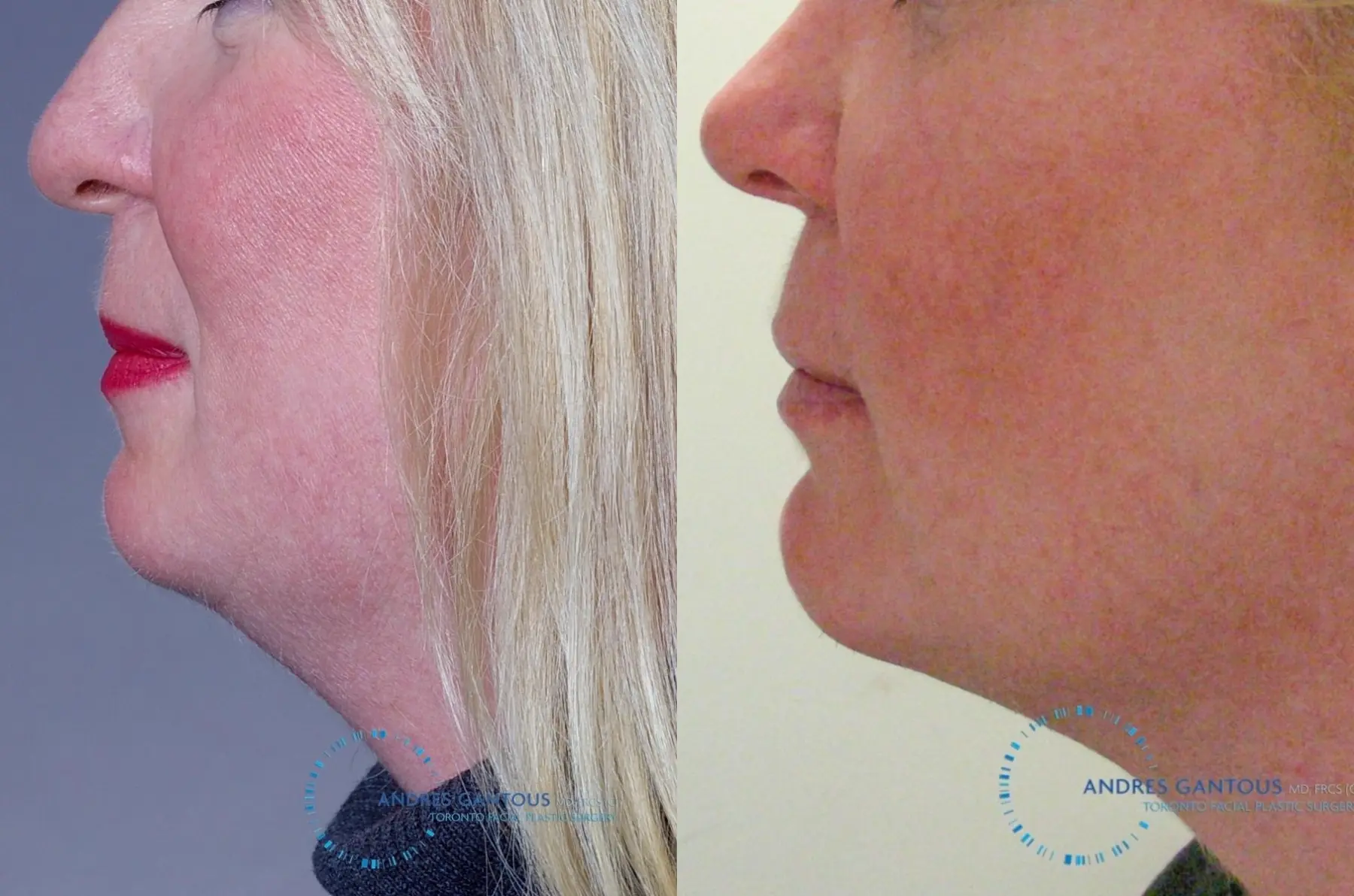 Chin Augmentation: Patient 9 - Before and After 3