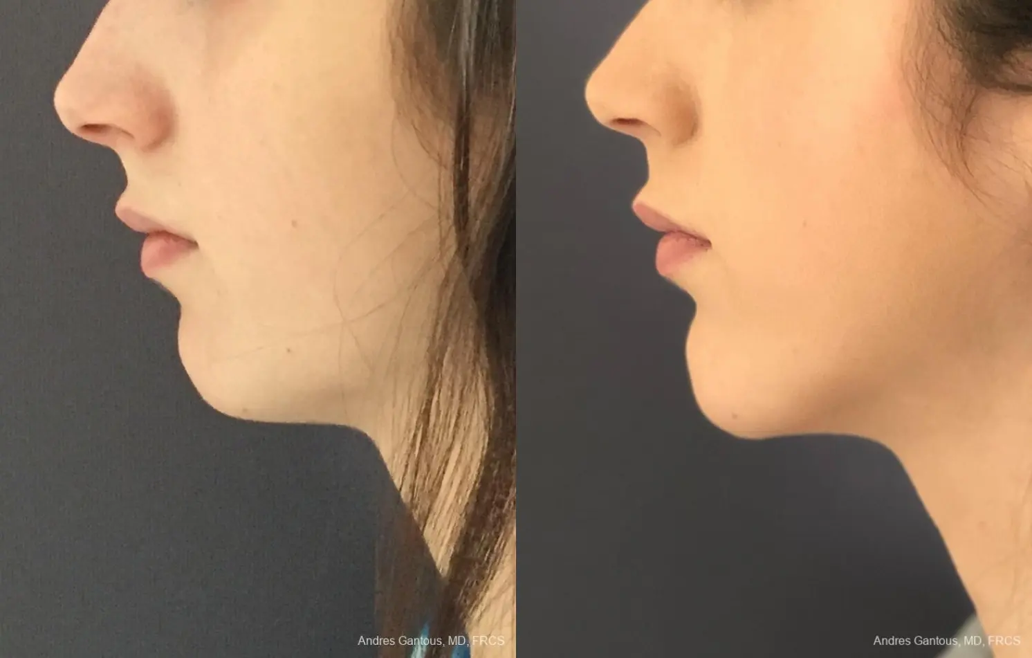 Chin Augmentation: Patient 6 - Before and After 2