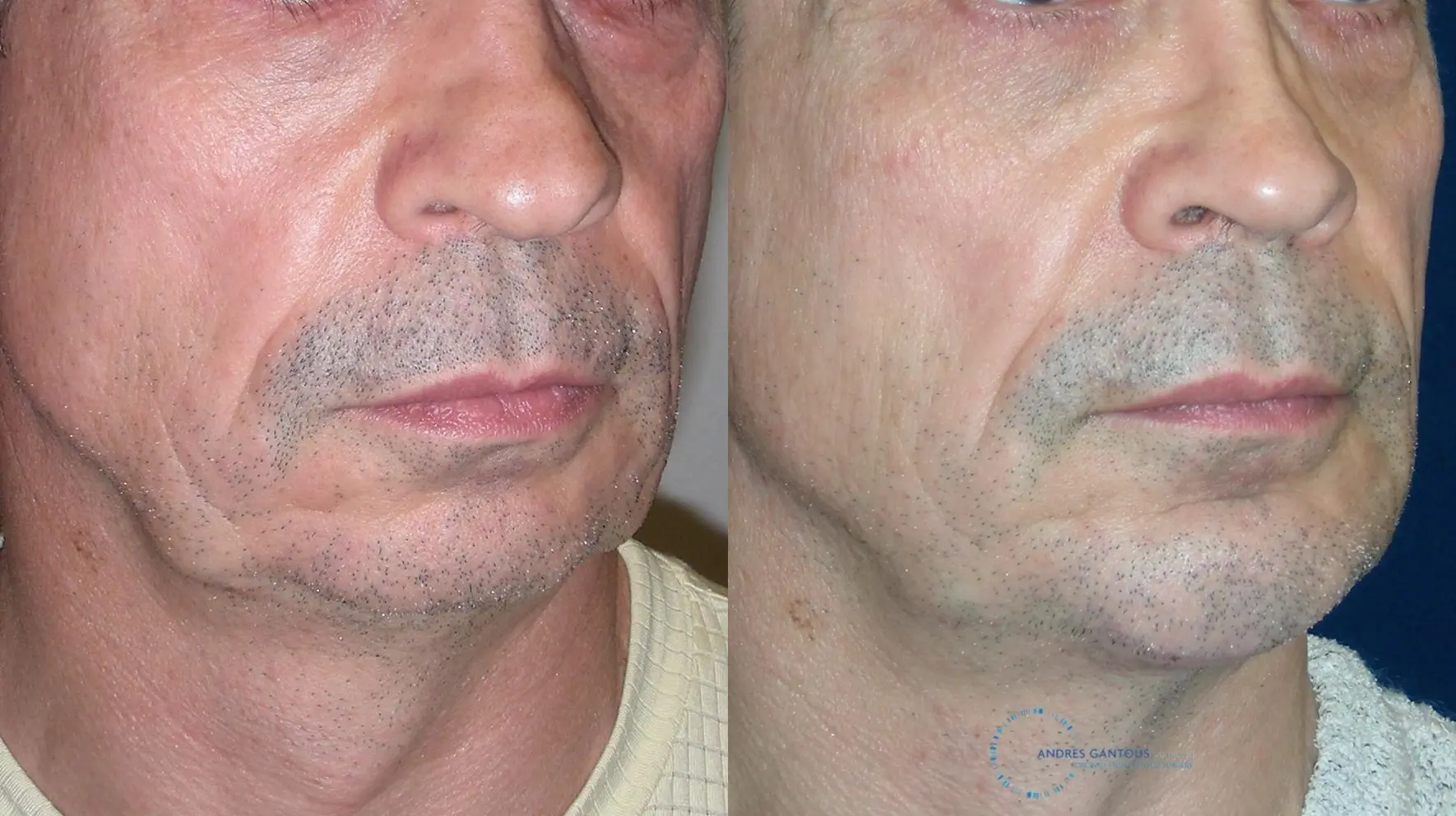 Chin Augmentation: Patient 3 - Before and After 2