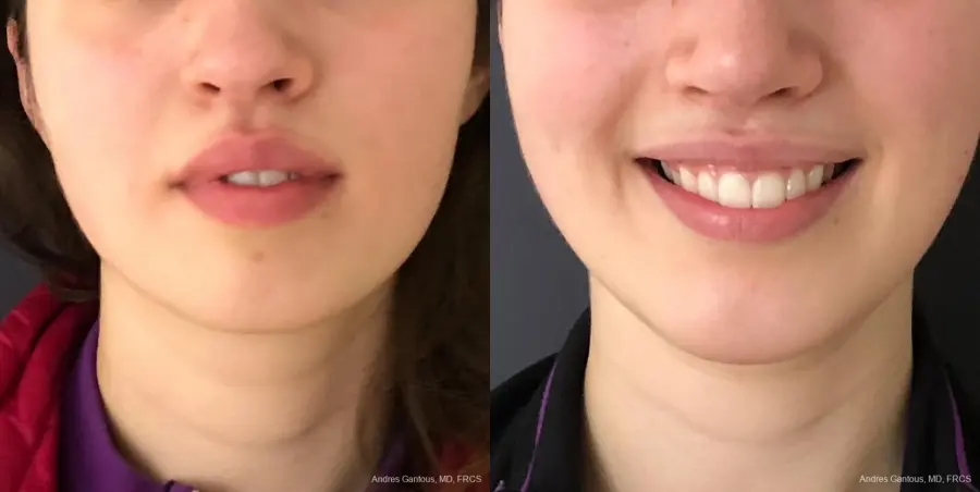 Chin Augmentation: Patient 5 - Before and After  