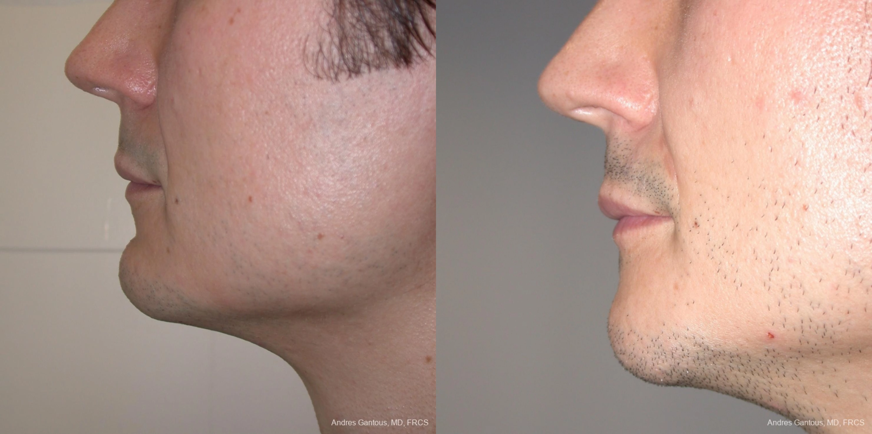 Chin Augmentation - Thumbnail 2