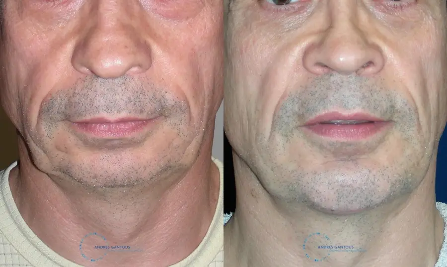 Chin Augmentation: Patient 3 - Before and After  