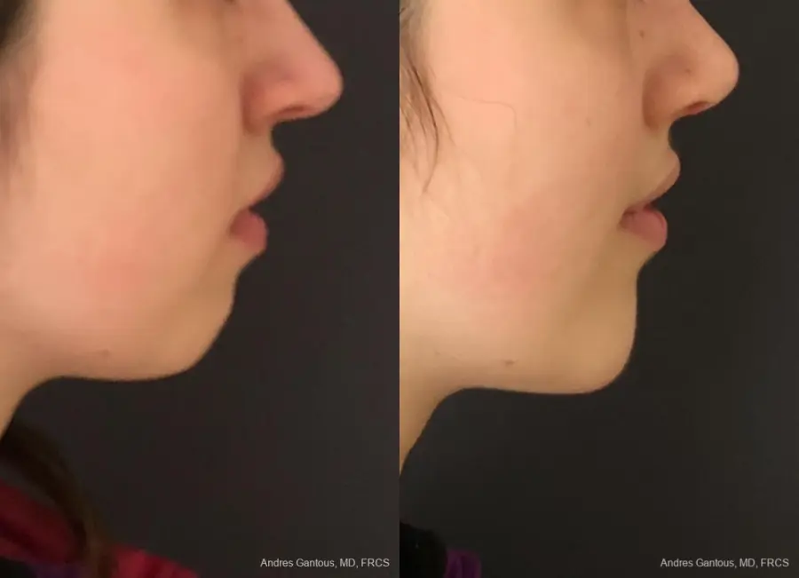 Chin Augmentation: Patient 5 - Before and After 3