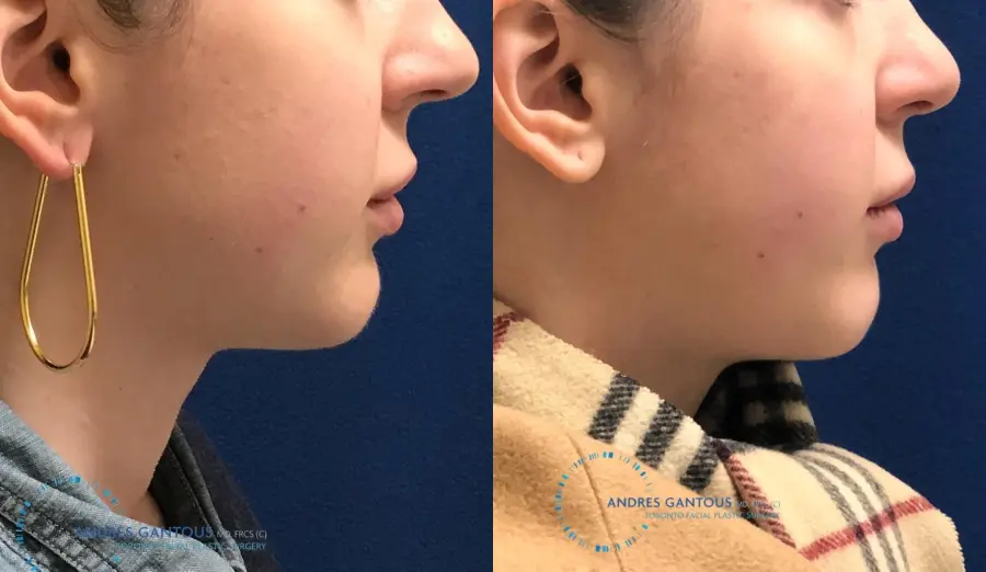 Chin Augmentation: Patient 8 - Before and After 3