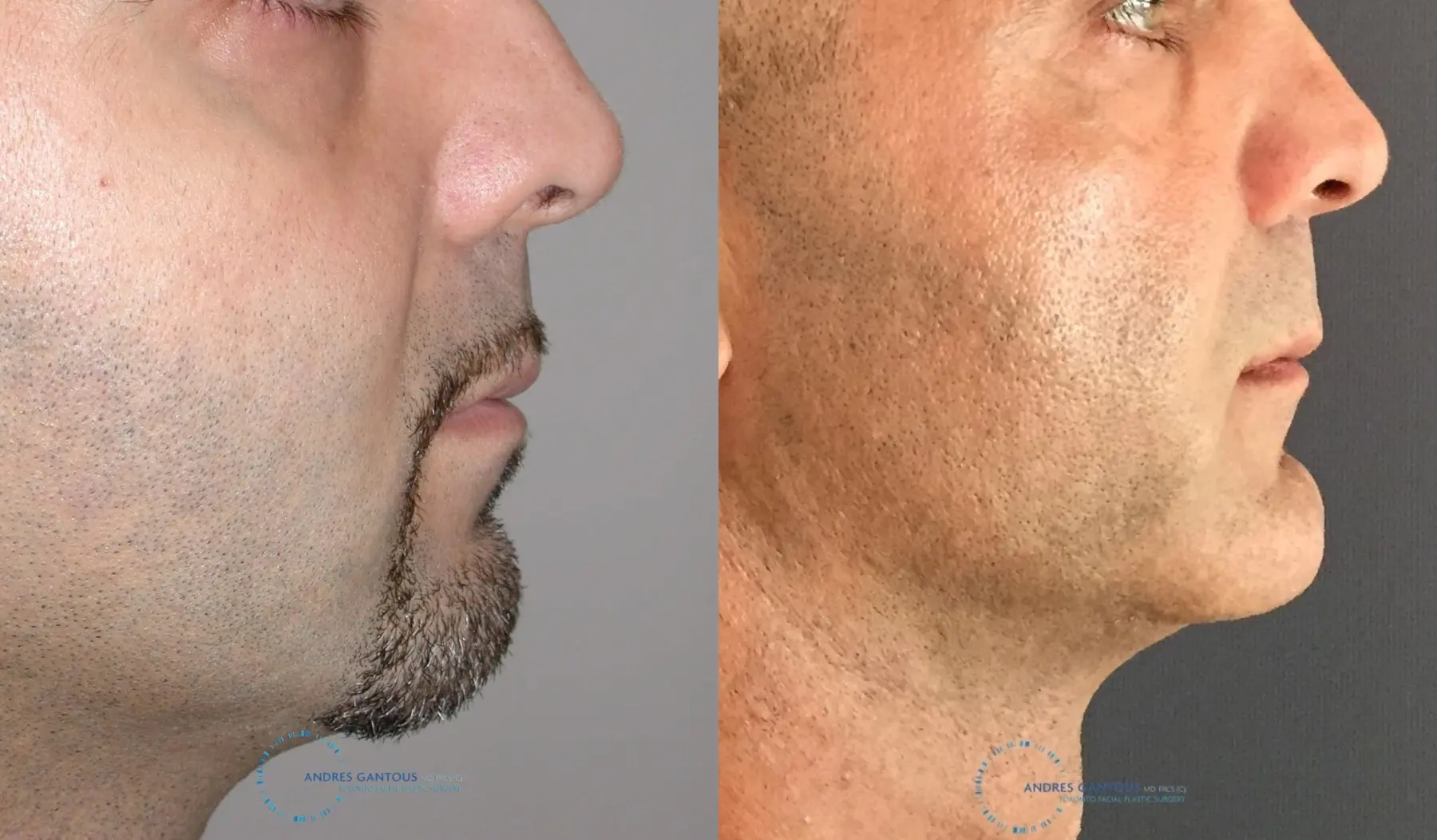 Chin Augmentation: Patient 2 - Before and After 3