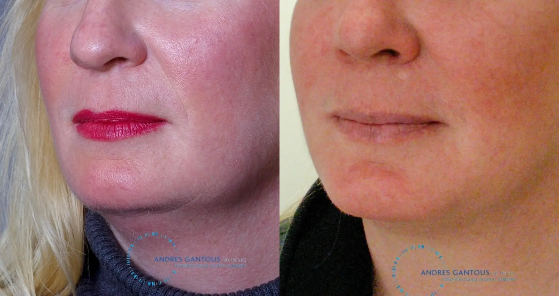 Chin Augmentation: Patient 9 - Before and After 2