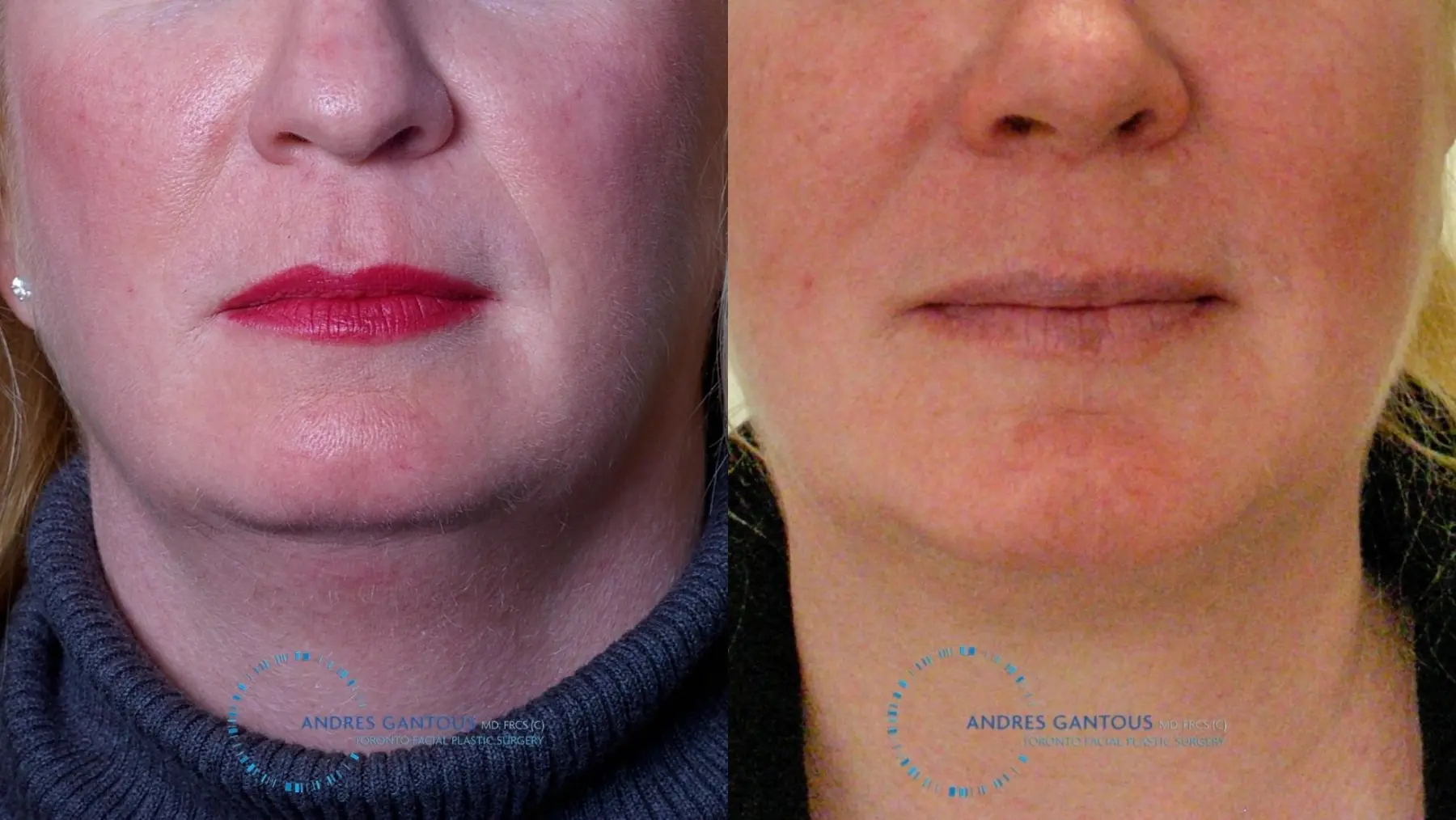 Chin Augmentation: Patient 9 - Before and After 1