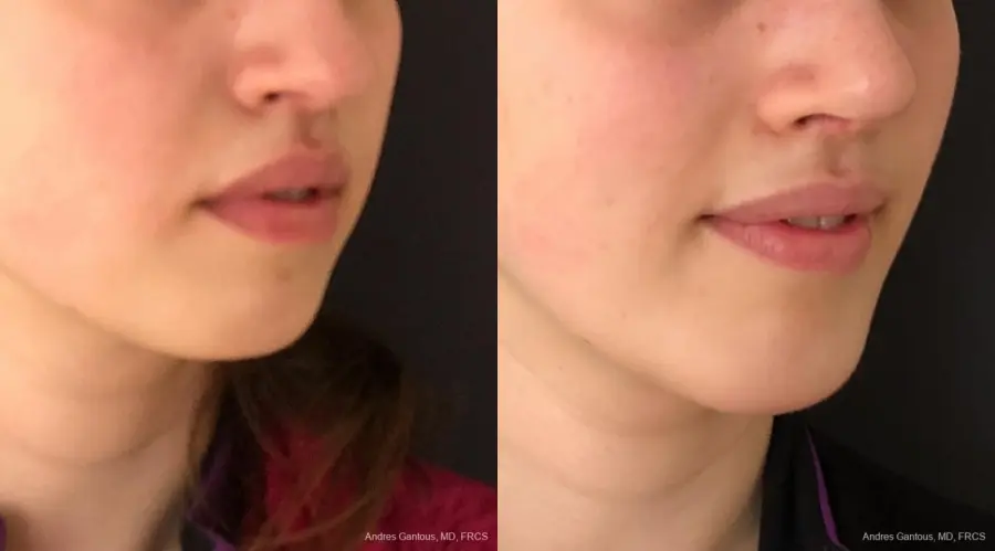 Chin Augmentation: Patient 5 - Before and After 2
