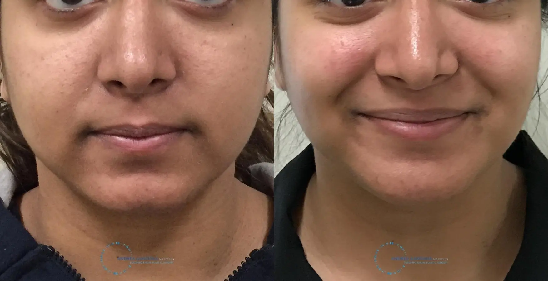 Chin Augmentation: Patient 4 - Before and After  