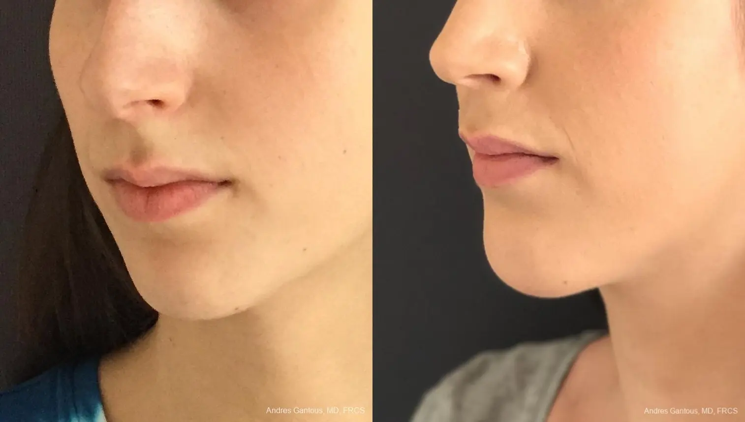 Chin Augmentation: Patient 6 - Before and After 1