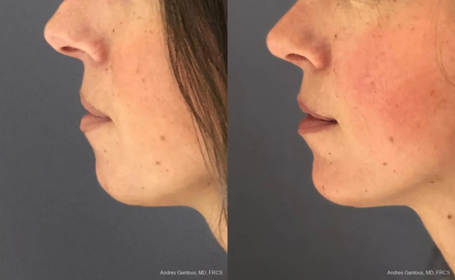 Chin Augmentation: Patient 7 - Before and After 2