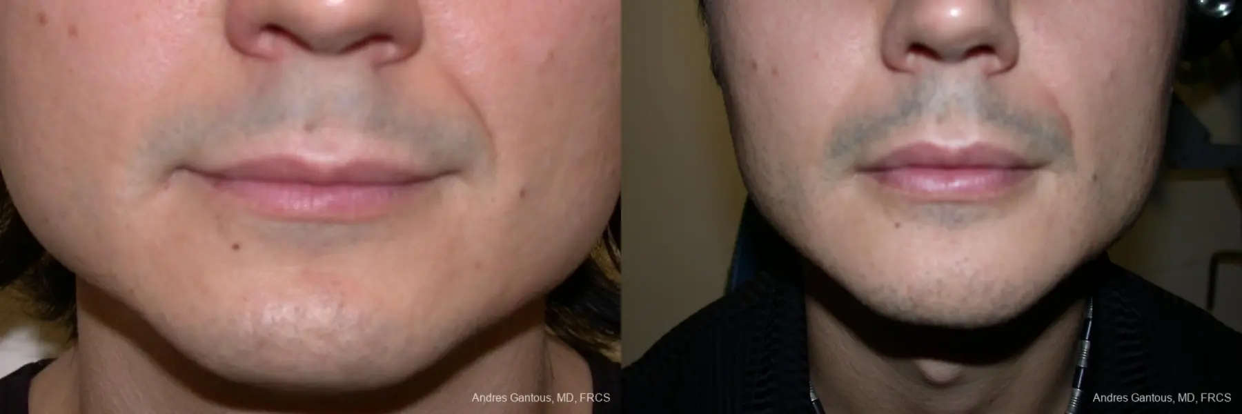 Chin Augmentation: Patient 1 - Before and After 1