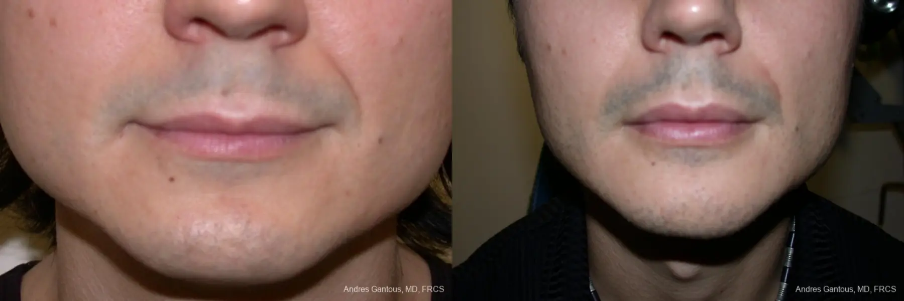 Chin Augmentation: Patient 1 - Before and After  