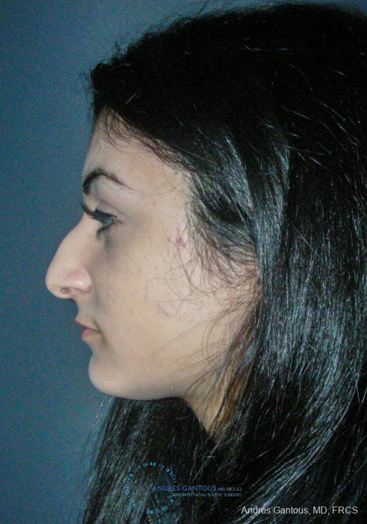 Rhinoplasty: Patient 87 - Before and After 6