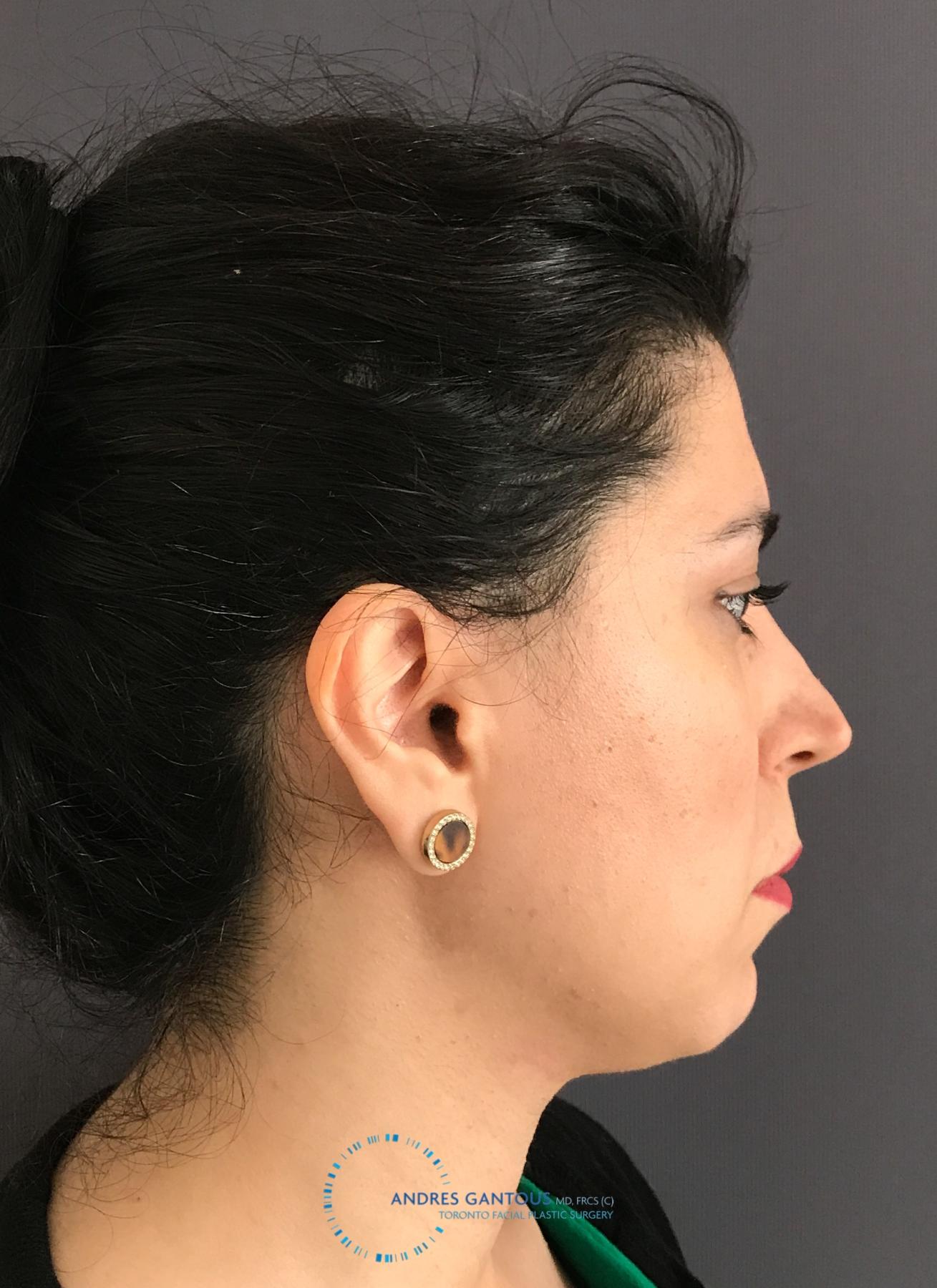 Revision Rhinoplasty: Patient 18 - Before 5