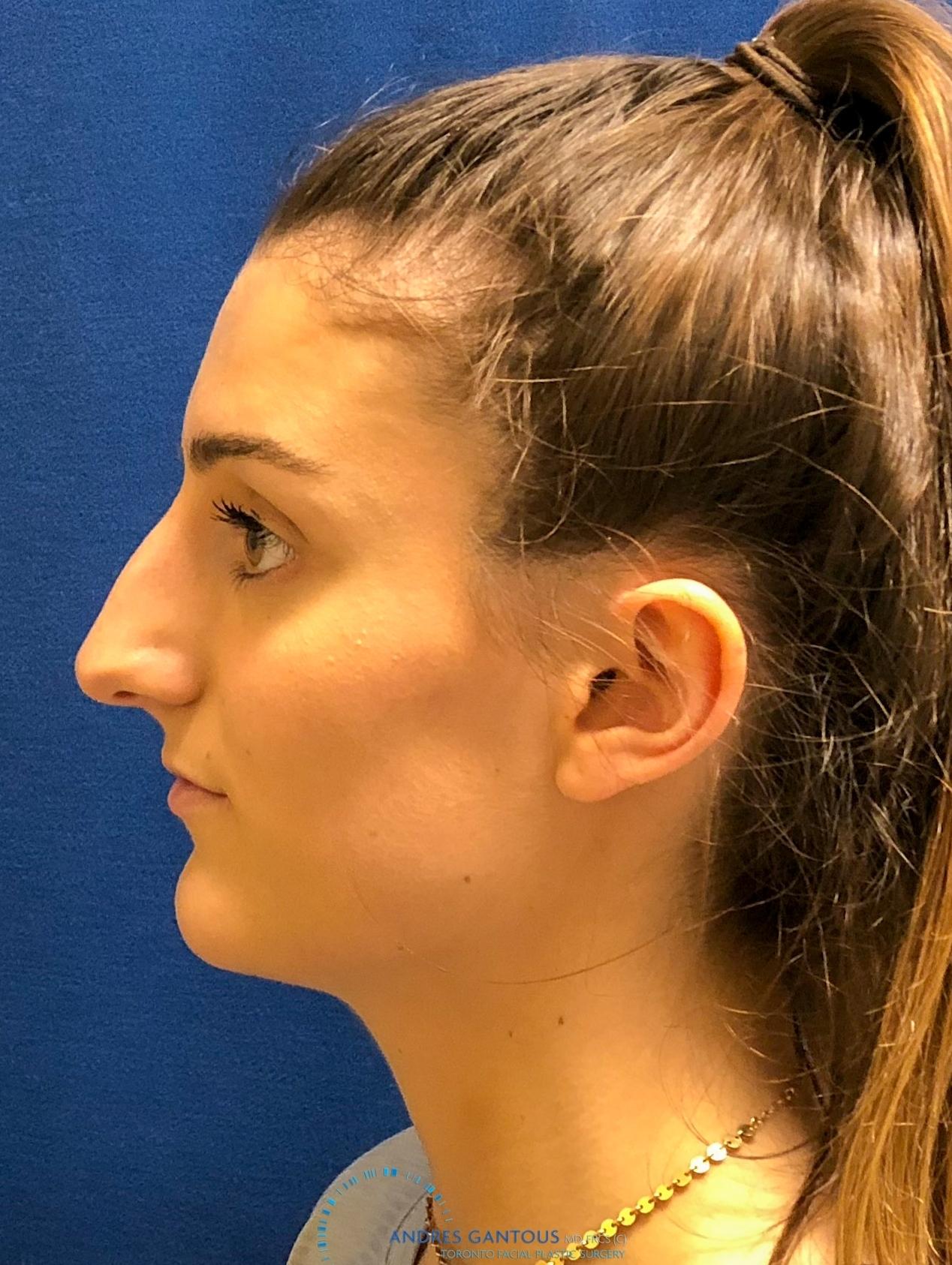 Rhinoplasty: Patient 6 - Before and After 6
