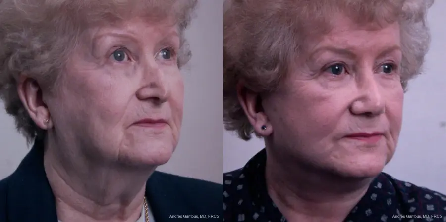 Facelift & Neck Lift: Patient 7 - Before and After 2