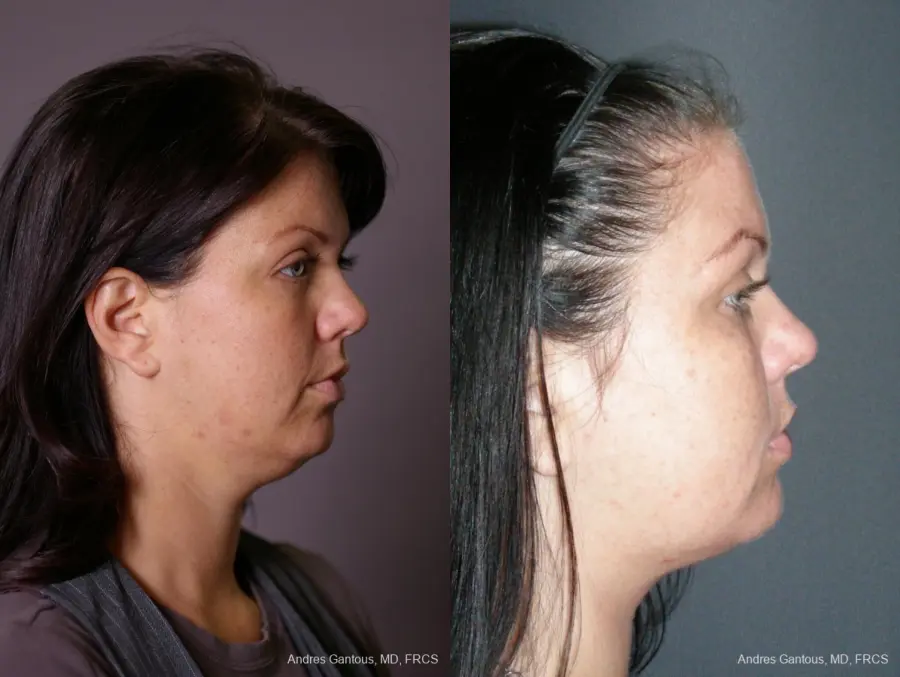 Facelift & Neck Lift: Patient 11 - Before and After 3