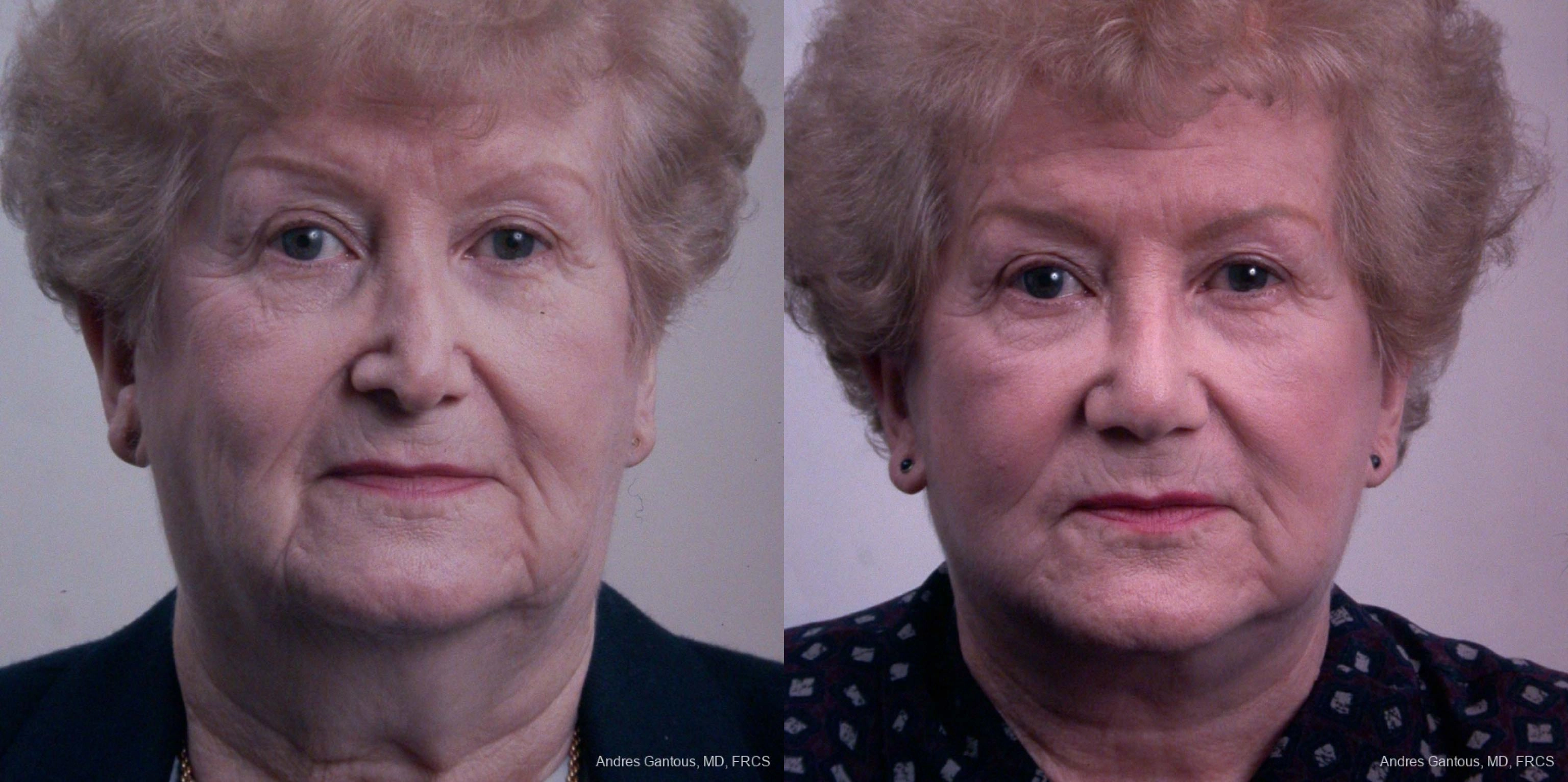 Before and after procedure result