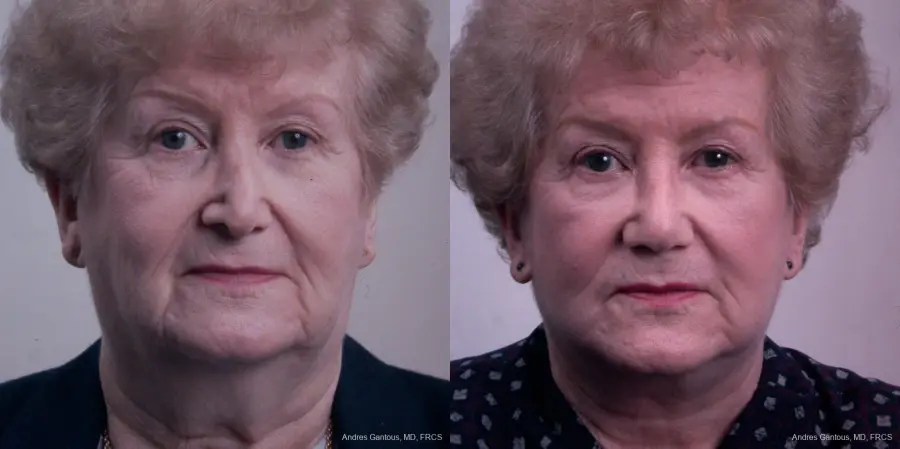 Facelift & Neck Lift: Patient 7 - Before and After 1