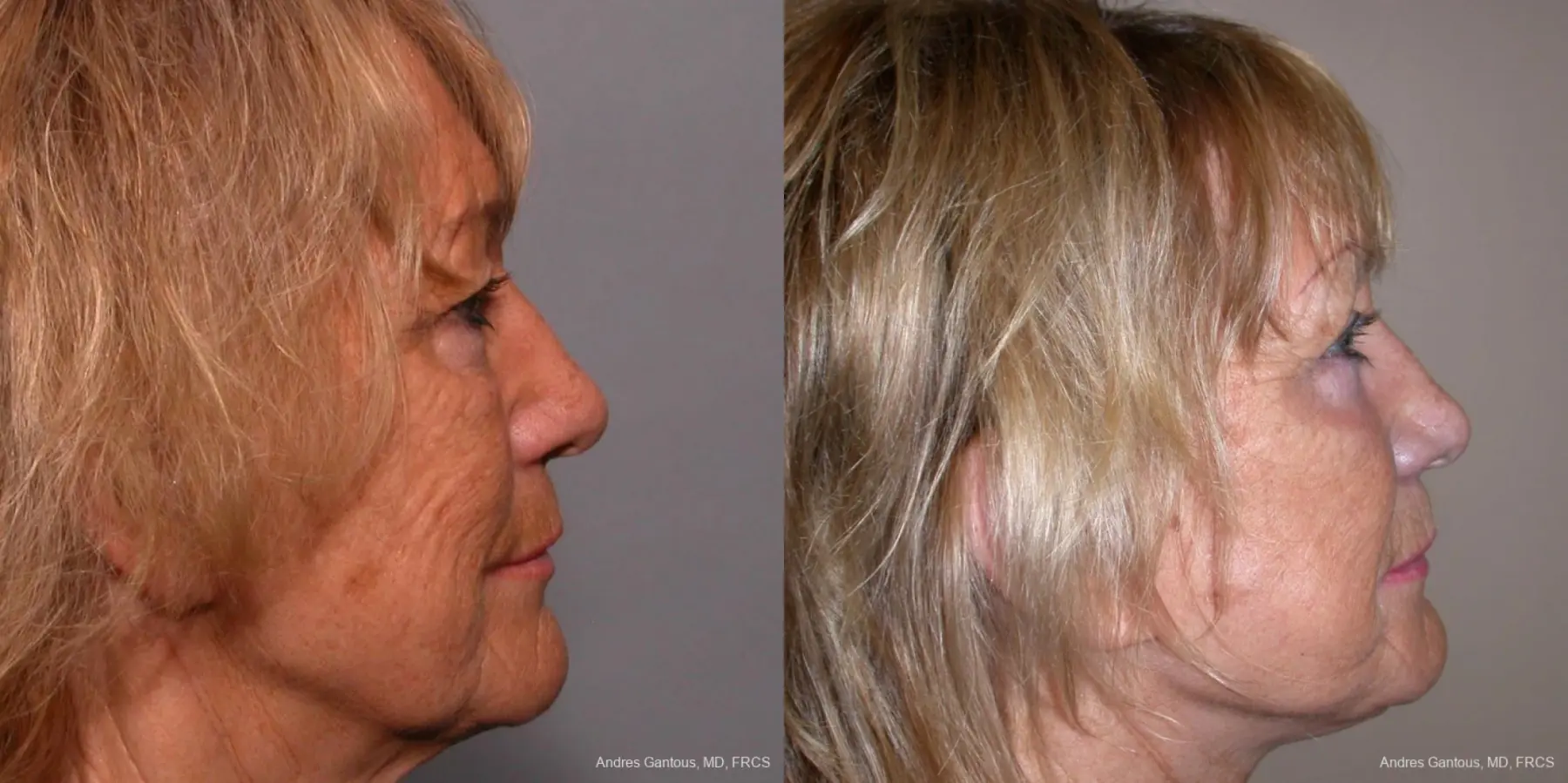 Facelift & Neck Lift: Patient 4 - Before and After 3
